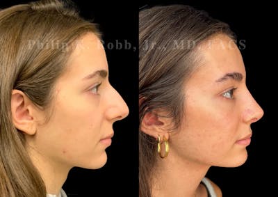 Ultrasonic Rhinoplasty Before & After Gallery - Patient 356035 - Image 1