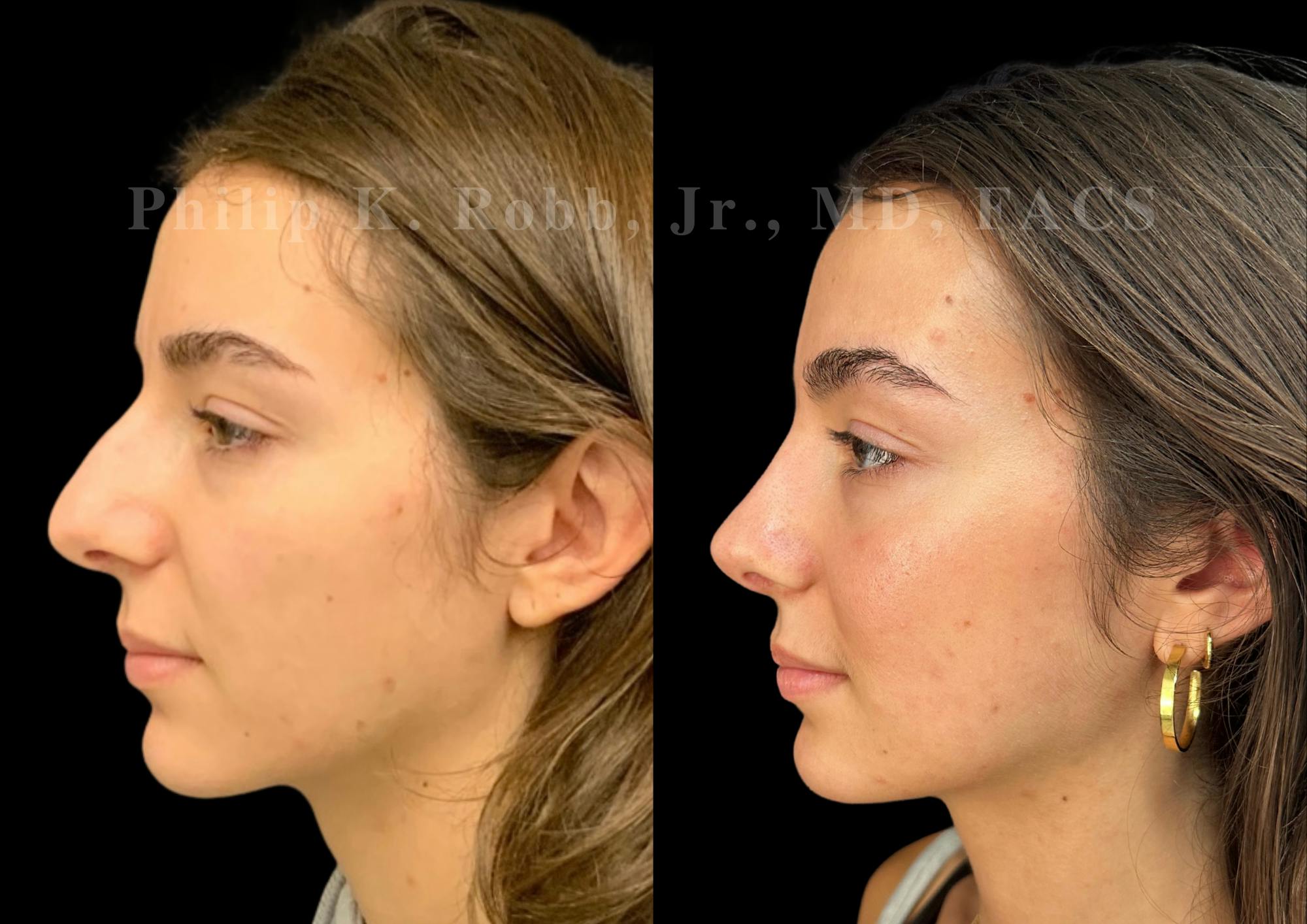 Ultrasonic Rhinoplasty Before & After Gallery - Patient 356035 - Image 5