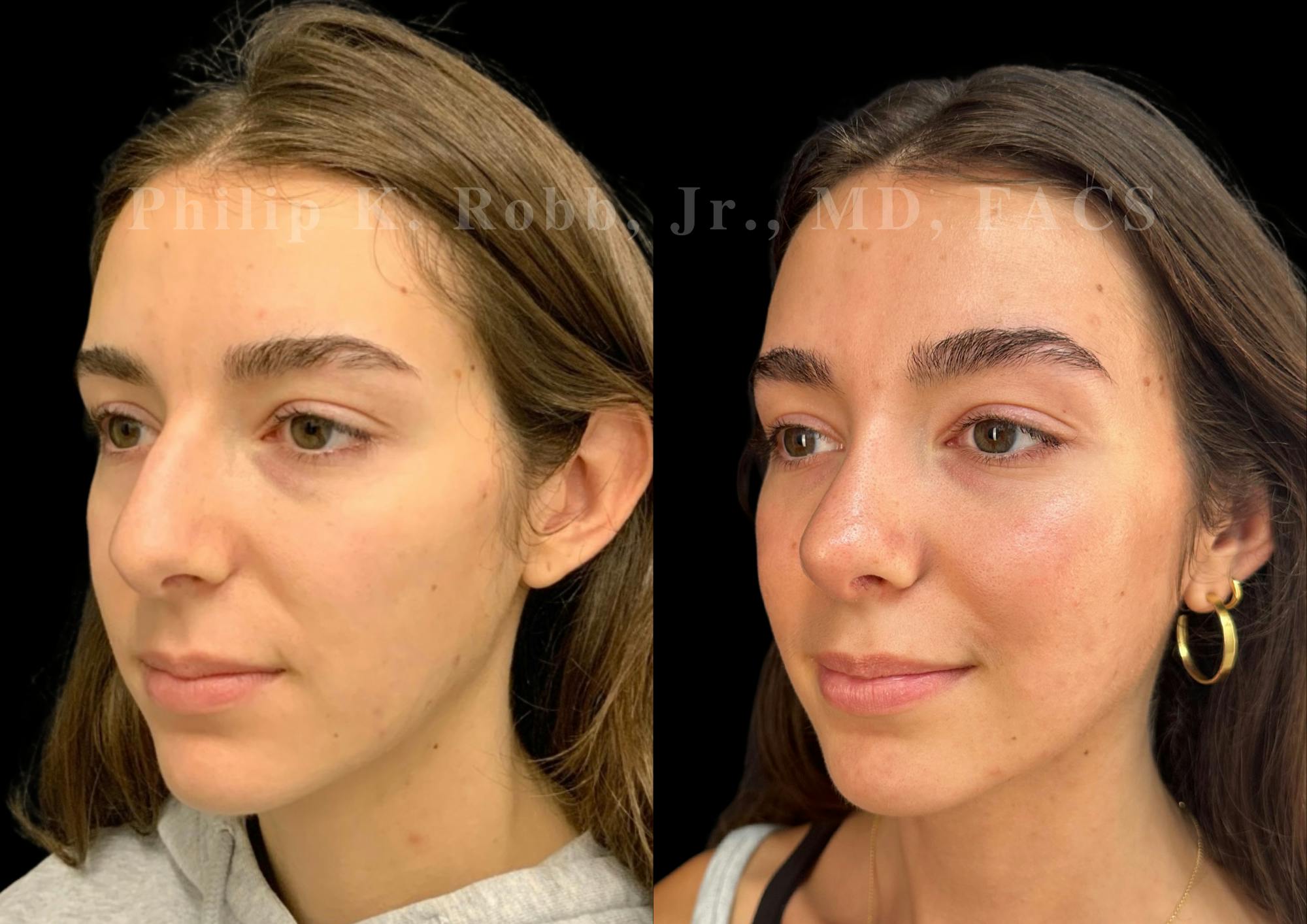 Ultrasonic Rhinoplasty Before & After Gallery - Patient 356035 - Image 4