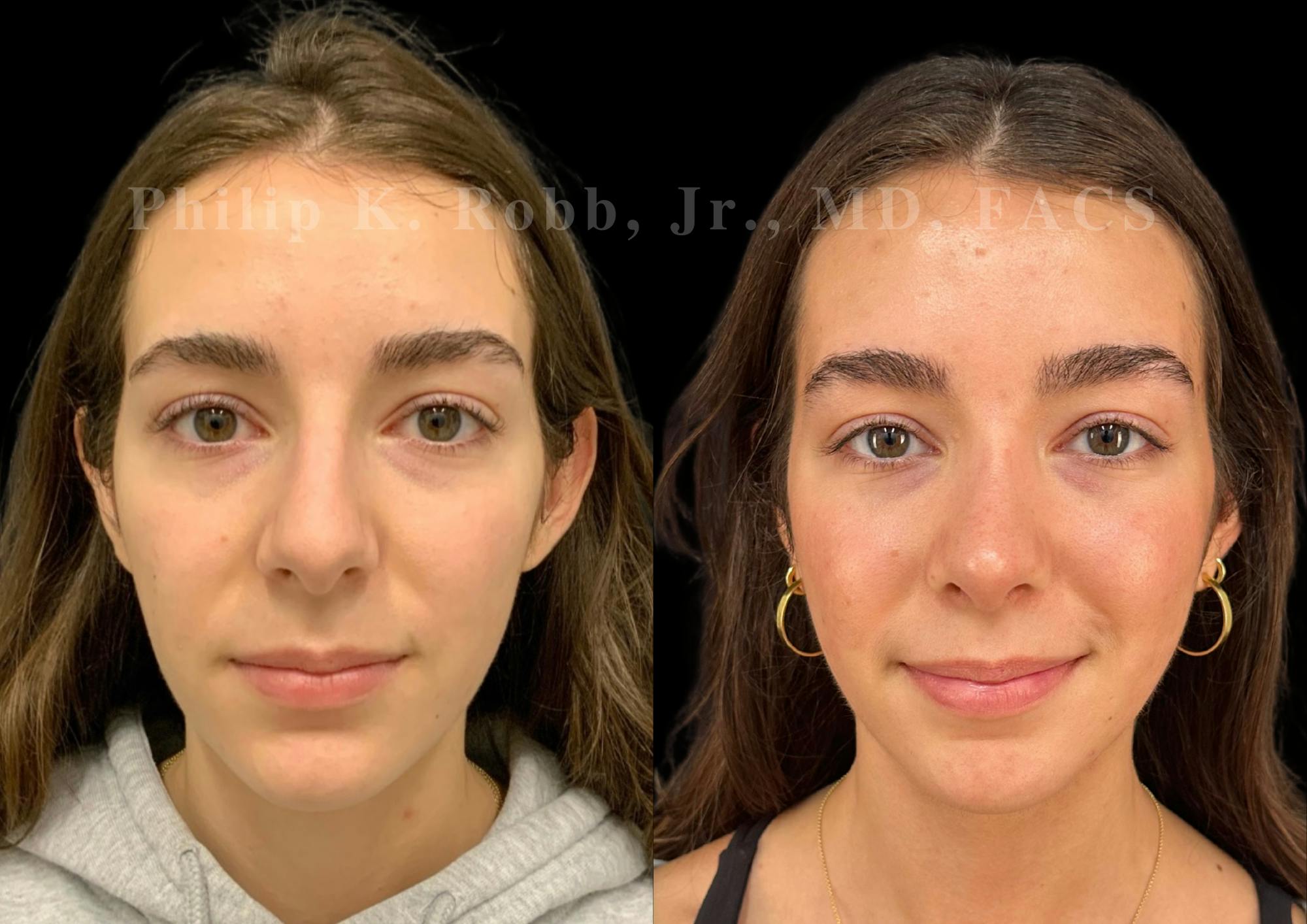 Ultrasonic Rhinoplasty Before & After Gallery - Patient 356035 - Image 3
