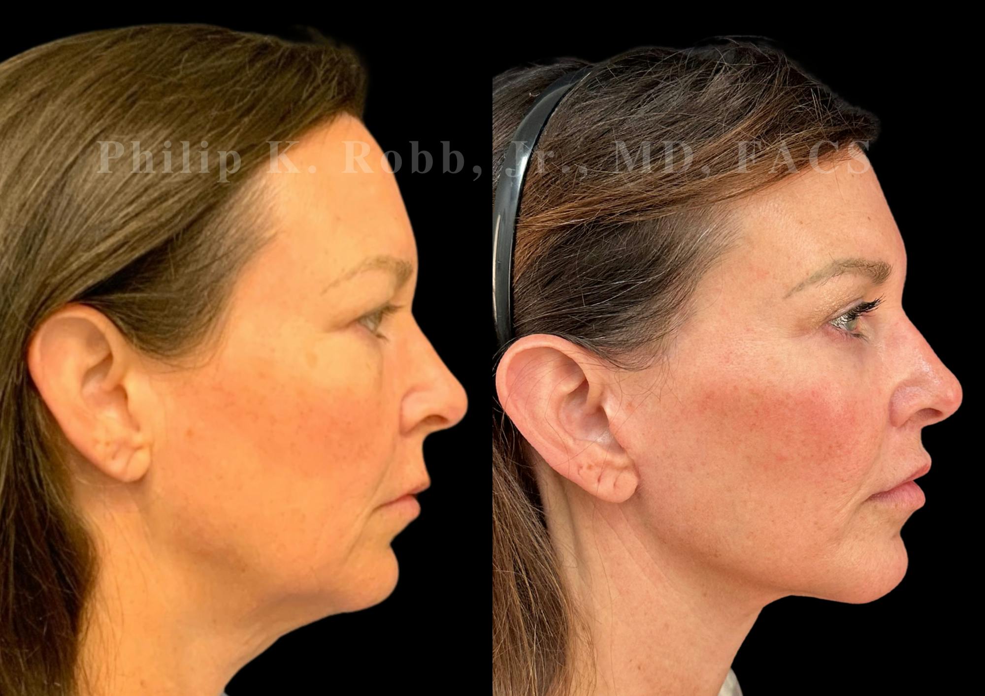 The Robb Refresh Before & After Gallery - Patient 335588 - Image 1