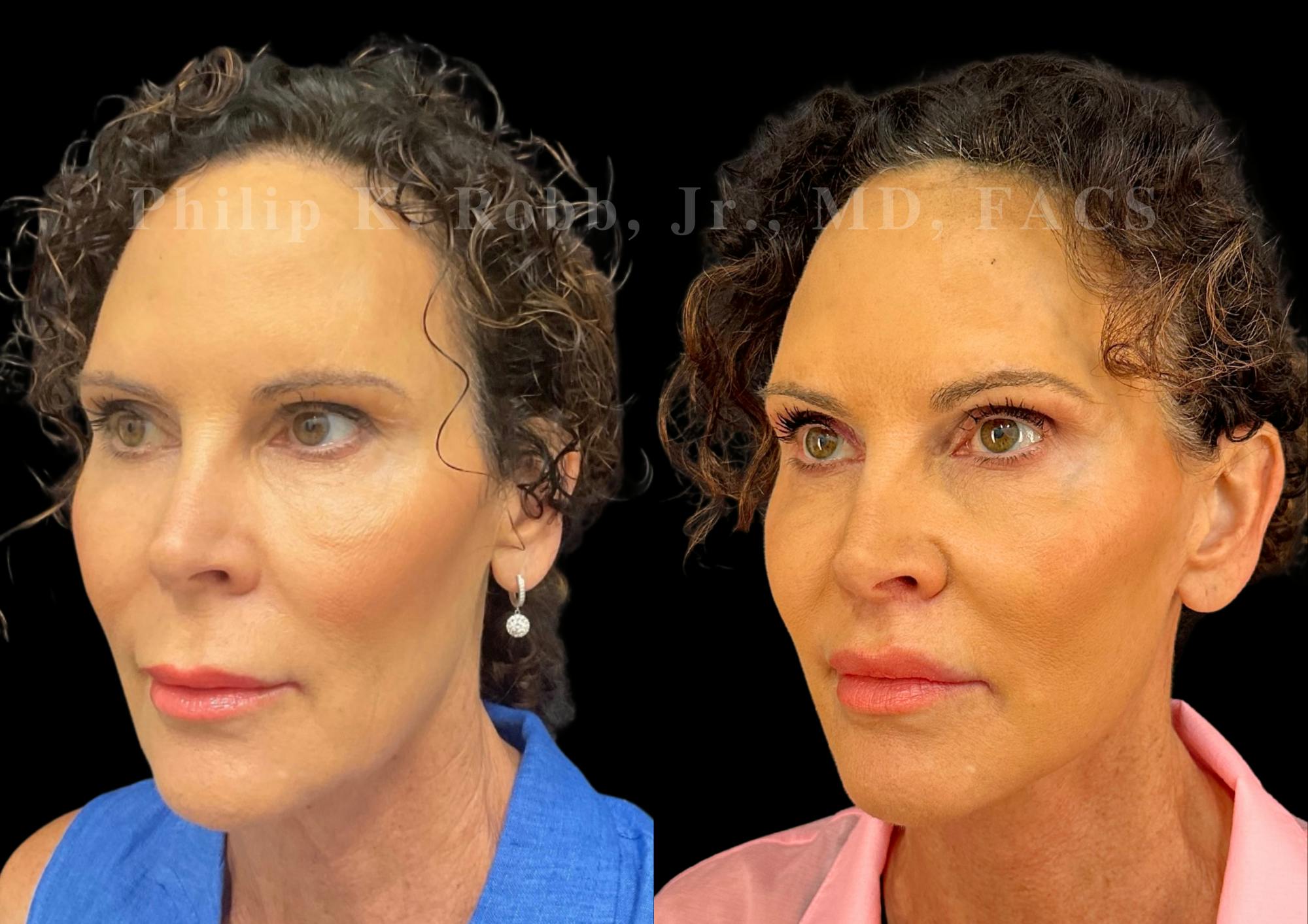 The Robb Refresh Before & After Gallery - Patient 161630 - Image 7