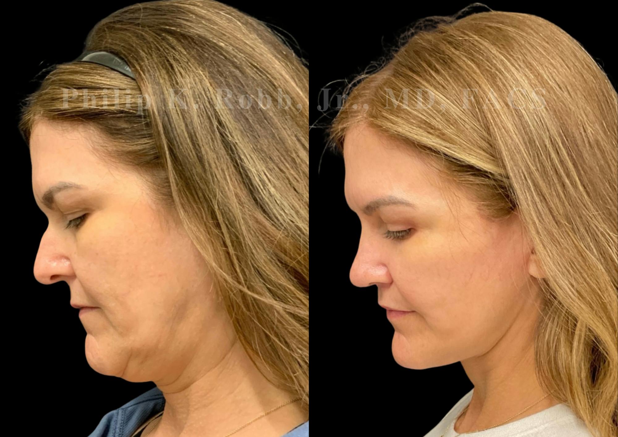 The Robb Refresh Before & After Gallery - Patient 709386 - Image 1