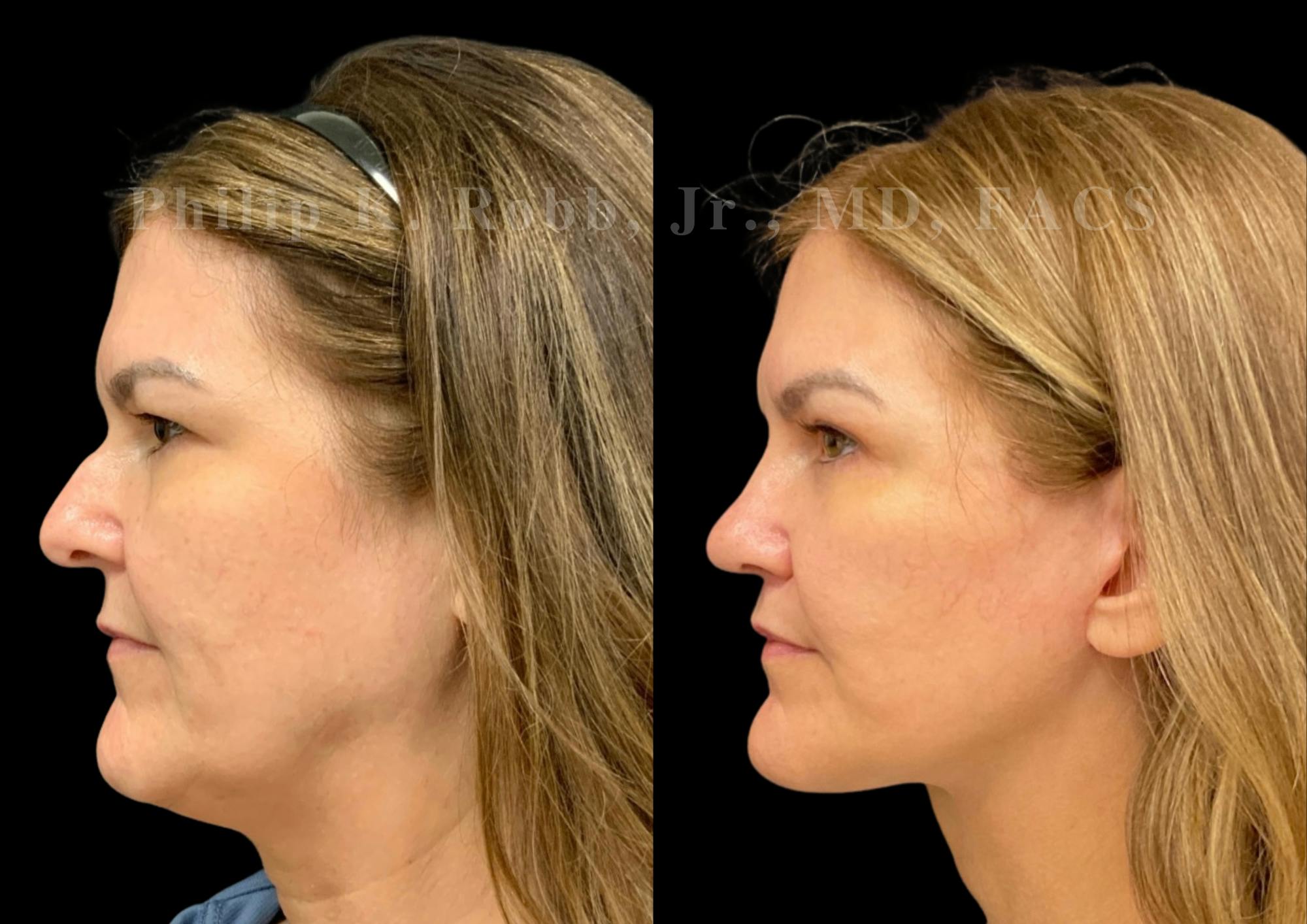 The Robb Refresh Before & After Gallery - Patient 709386 - Image 5