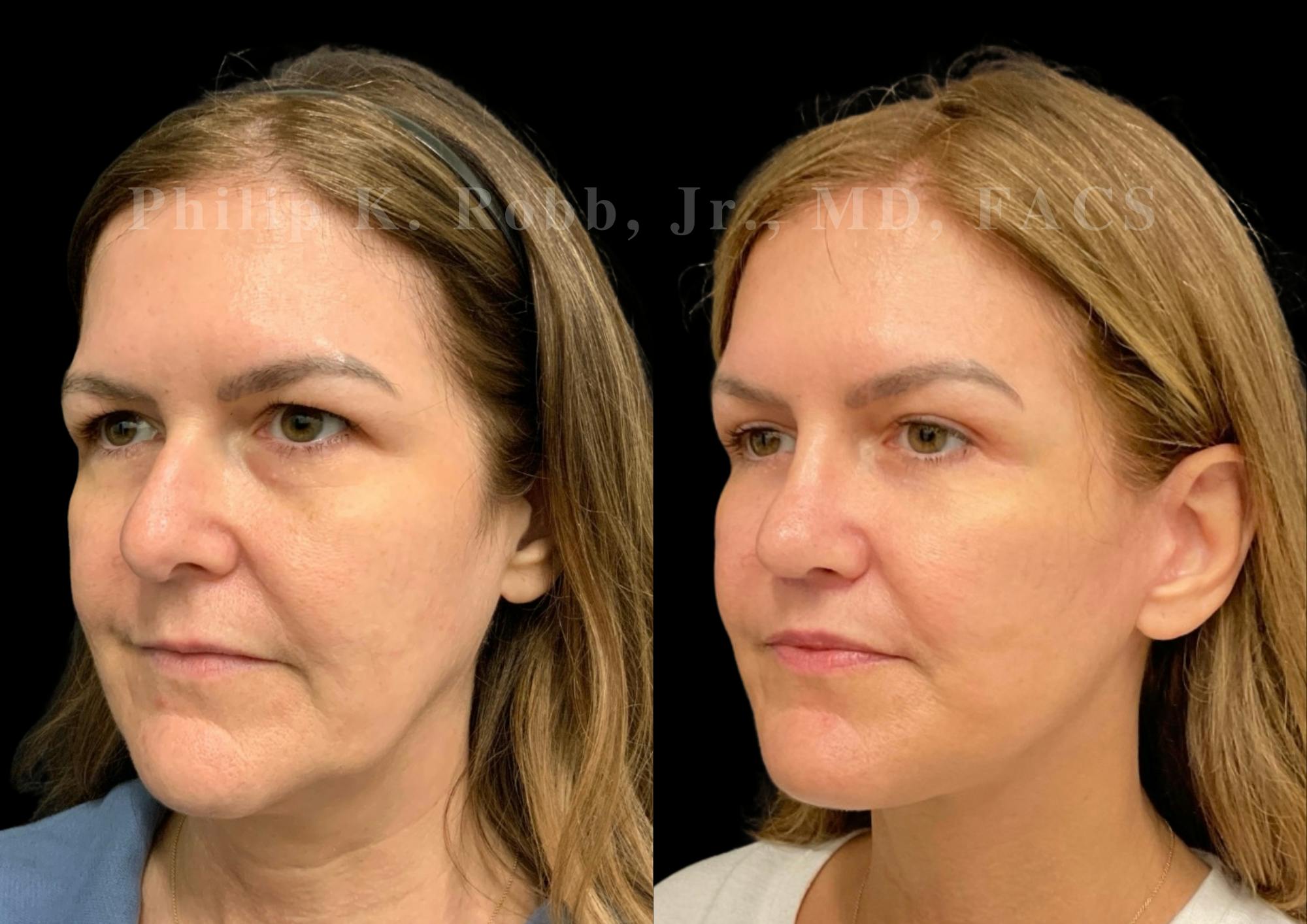 The Robb Refresh Before & After Gallery - Patient 709386 - Image 3
