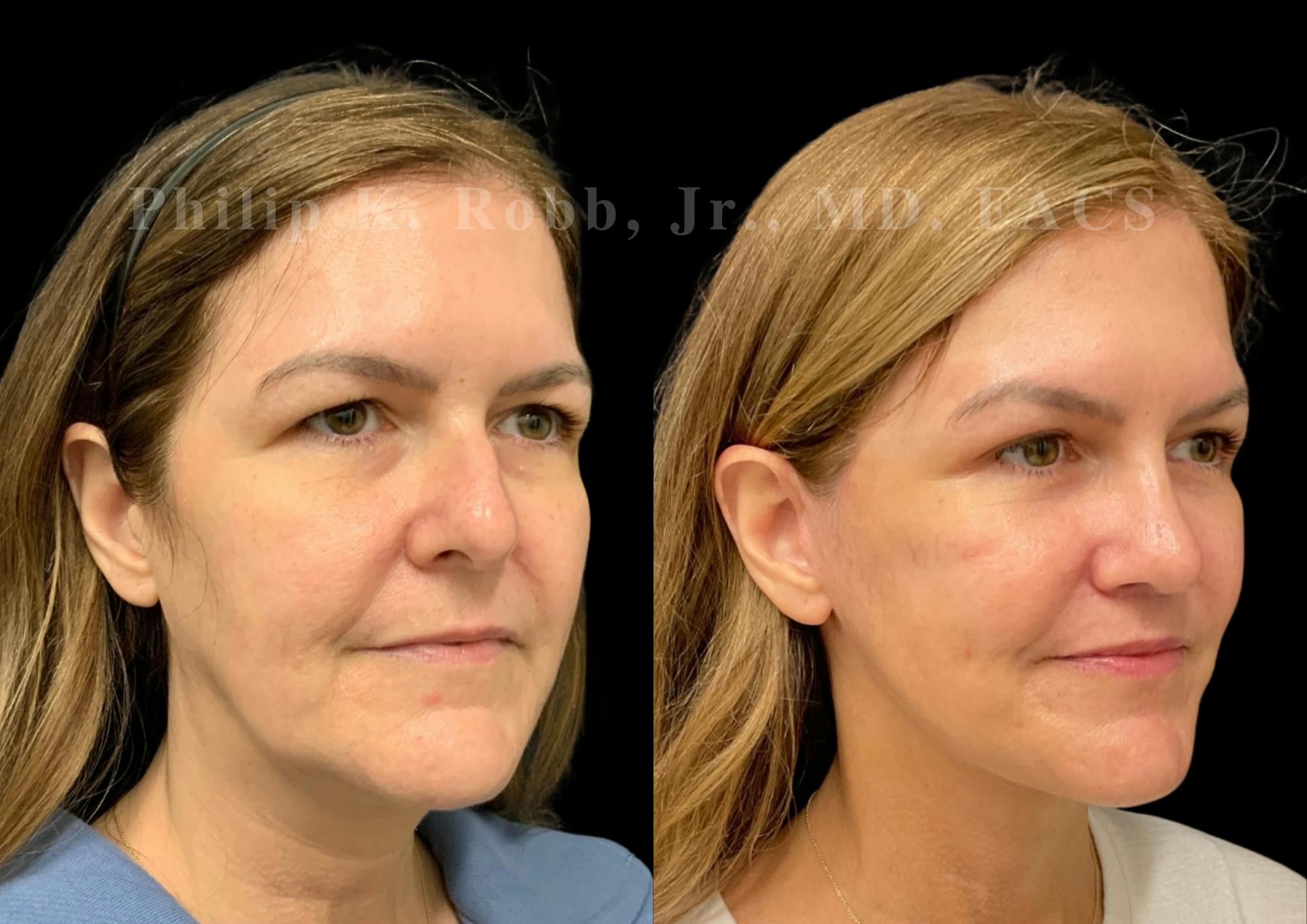 The Robb Refresh Before & After Gallery - Patient 709386 - Image 6