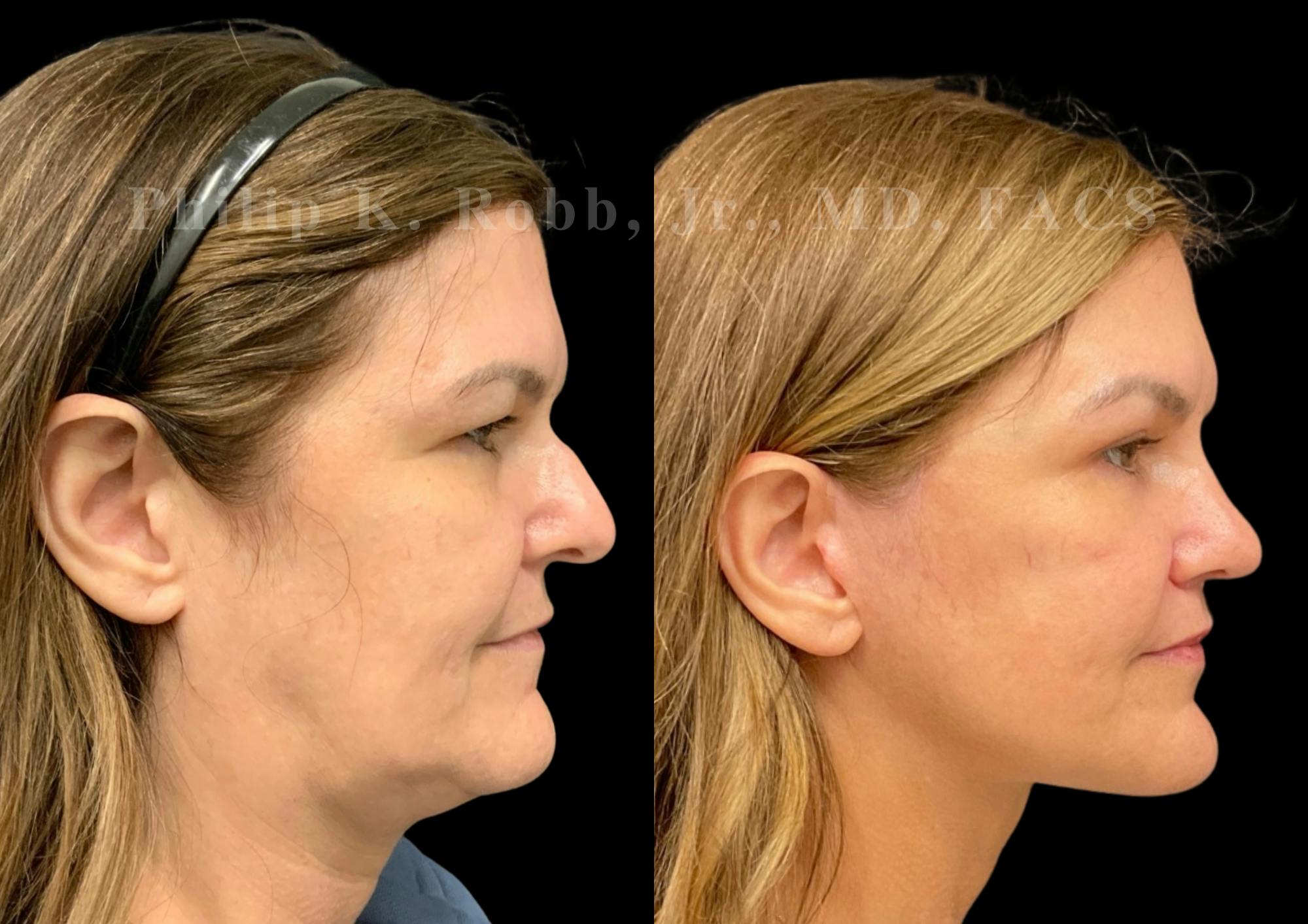 The Robb Refresh Before & After Gallery - Patient 709386 - Image 2