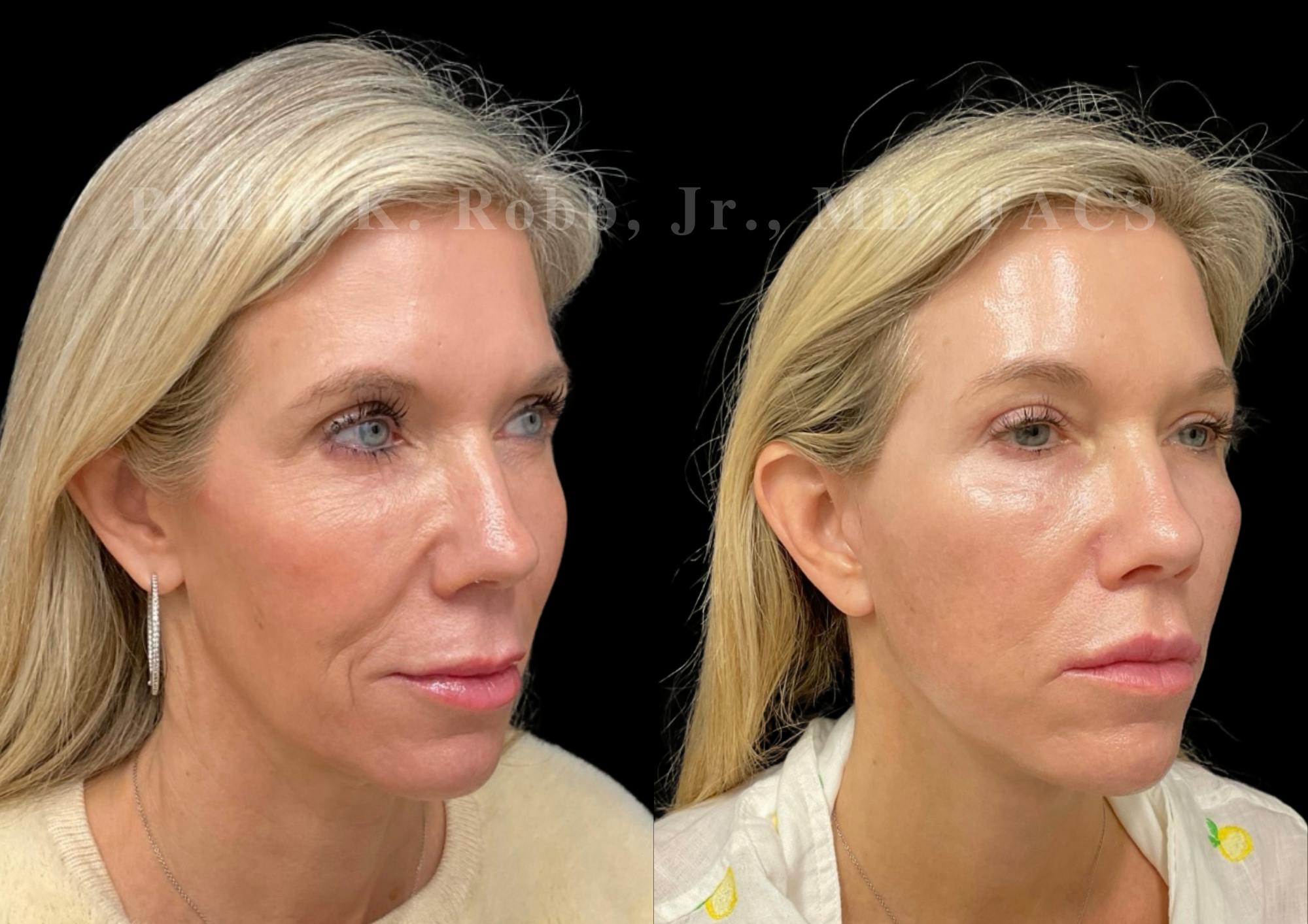 The Robb Refresh Before & After Gallery - Patient 336094 - Image 2