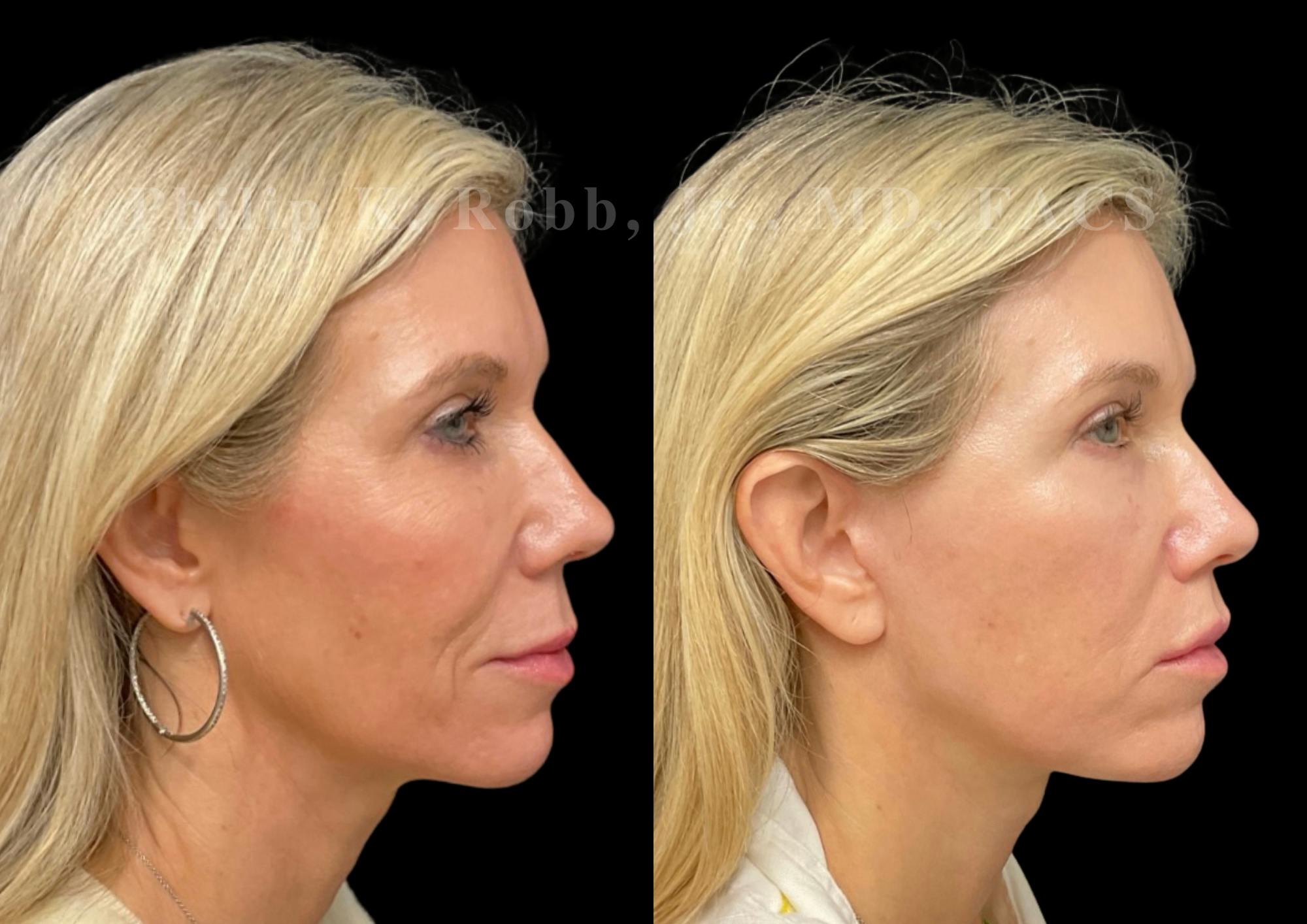 The Robb Refresh Before & After Gallery - Patient 336094 - Image 1