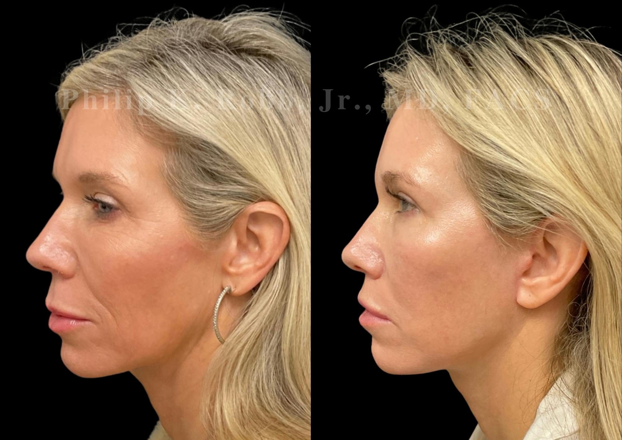 The Robb Refresh Before & After Gallery - Patient 336094 - Image 3