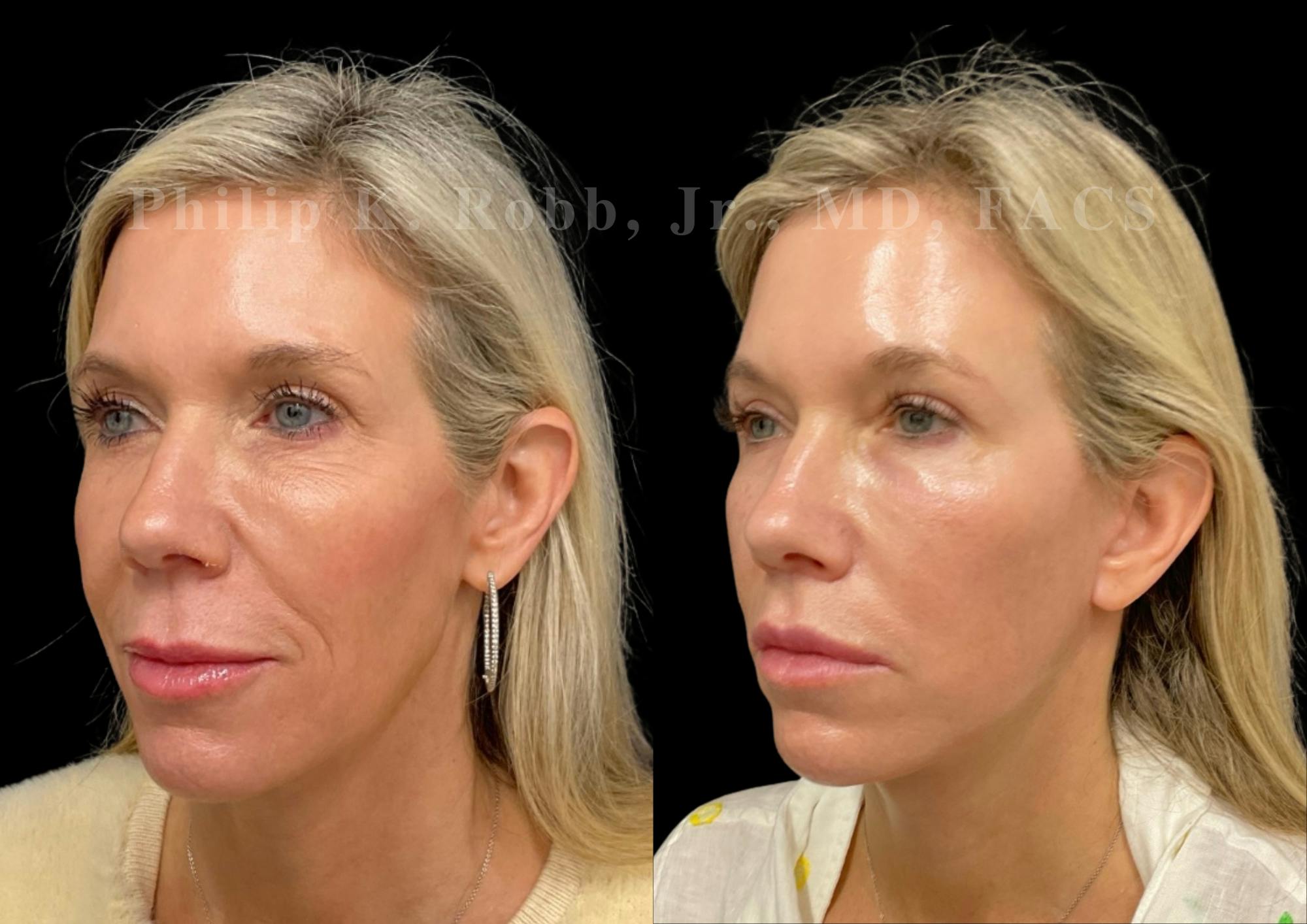 The Robb Refresh Before & After Gallery - Patient 336094 - Image 5