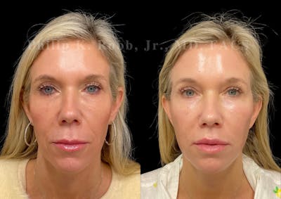 The Robb Refresh Before & After Gallery - Patient 336094 - Image 1