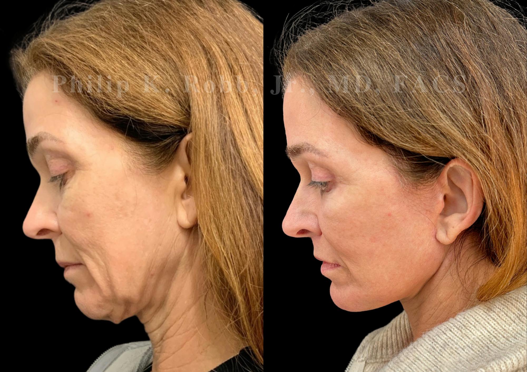 The Robb Refresh Before & After Gallery - Patient 397998 - Image 7