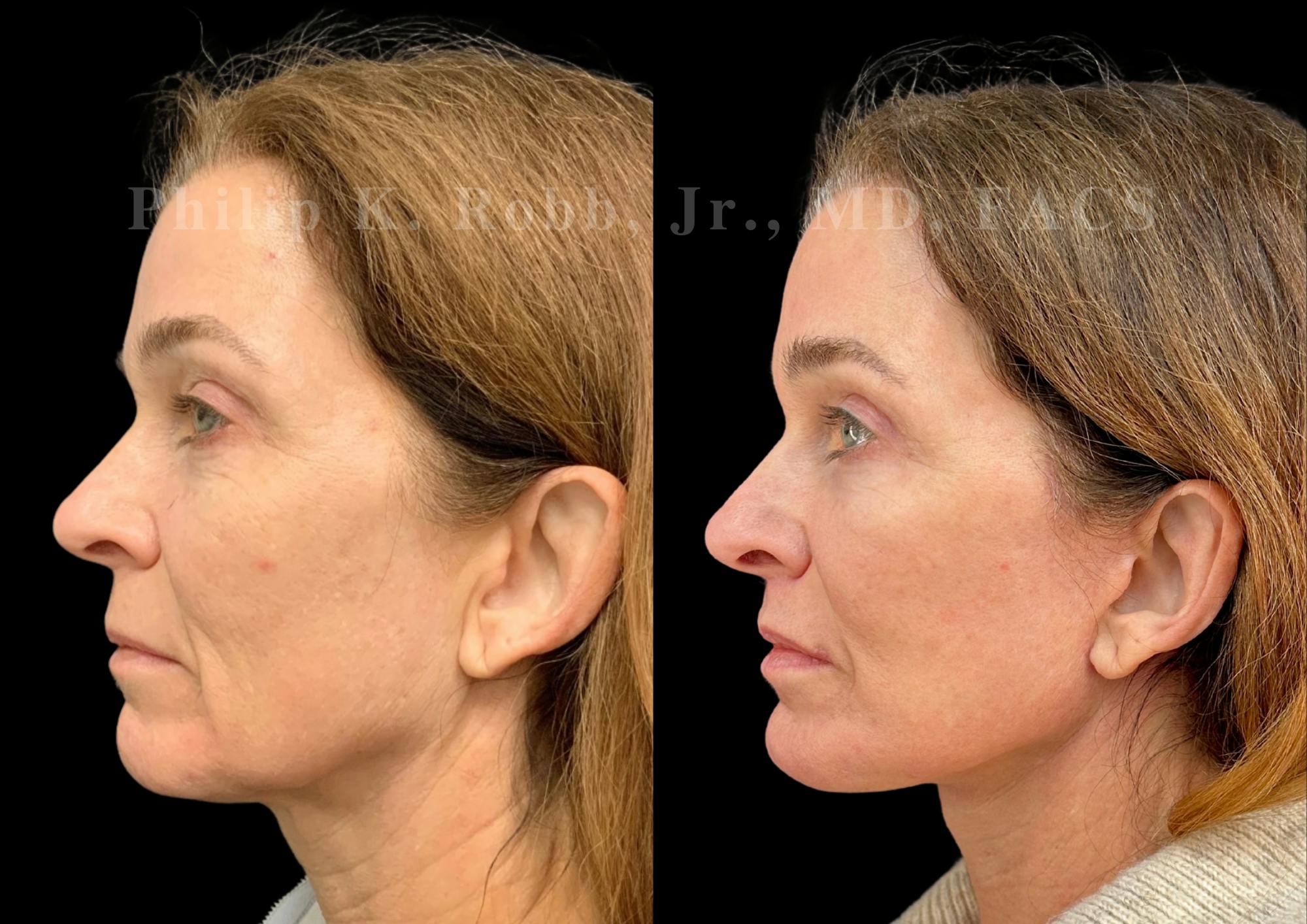 The Robb Refresh Before & After Gallery - Patient 397998 - Image 2