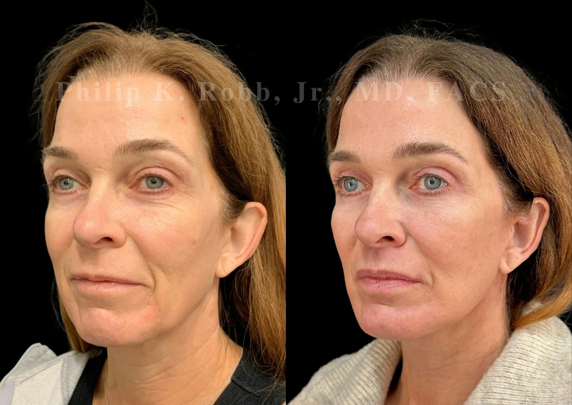 The Robb Refresh Before & After Gallery - Patient 397998 - Image 3