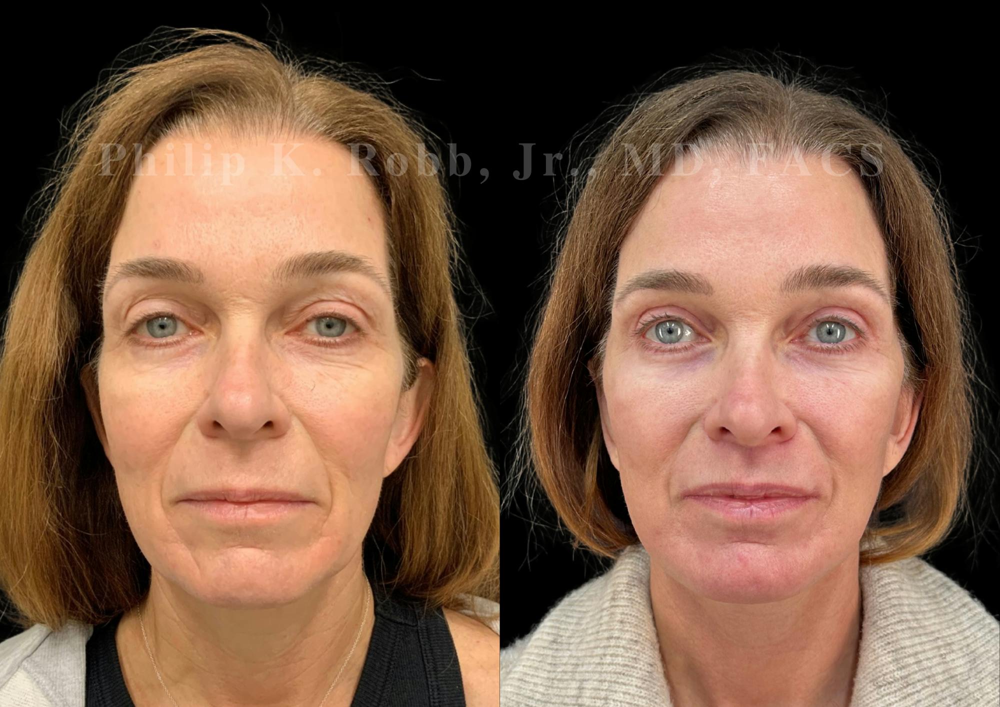 The Robb Refresh Before & After Gallery - Patient 397998 - Image 4