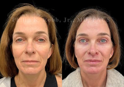 The Robb Refresh Before & After Gallery - Patient 397998 - Image 1