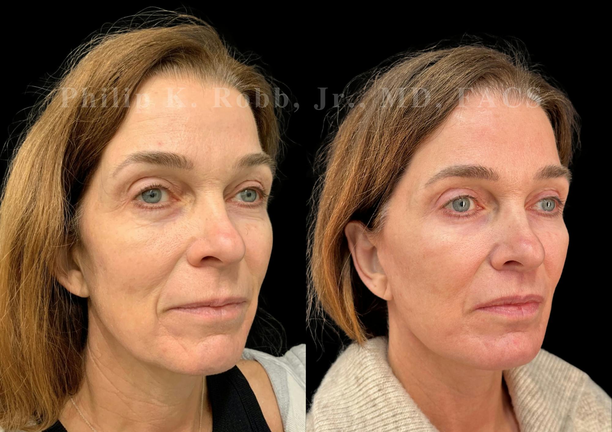 The Robb Refresh Before & After Gallery - Patient 397998 - Image 5