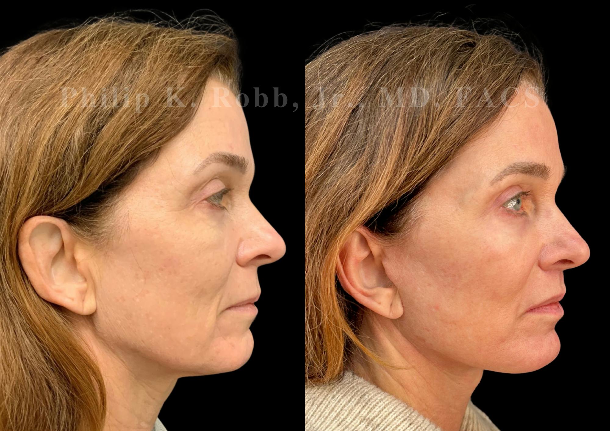 The Robb Refresh Before & After Gallery - Patient 397998 - Image 1