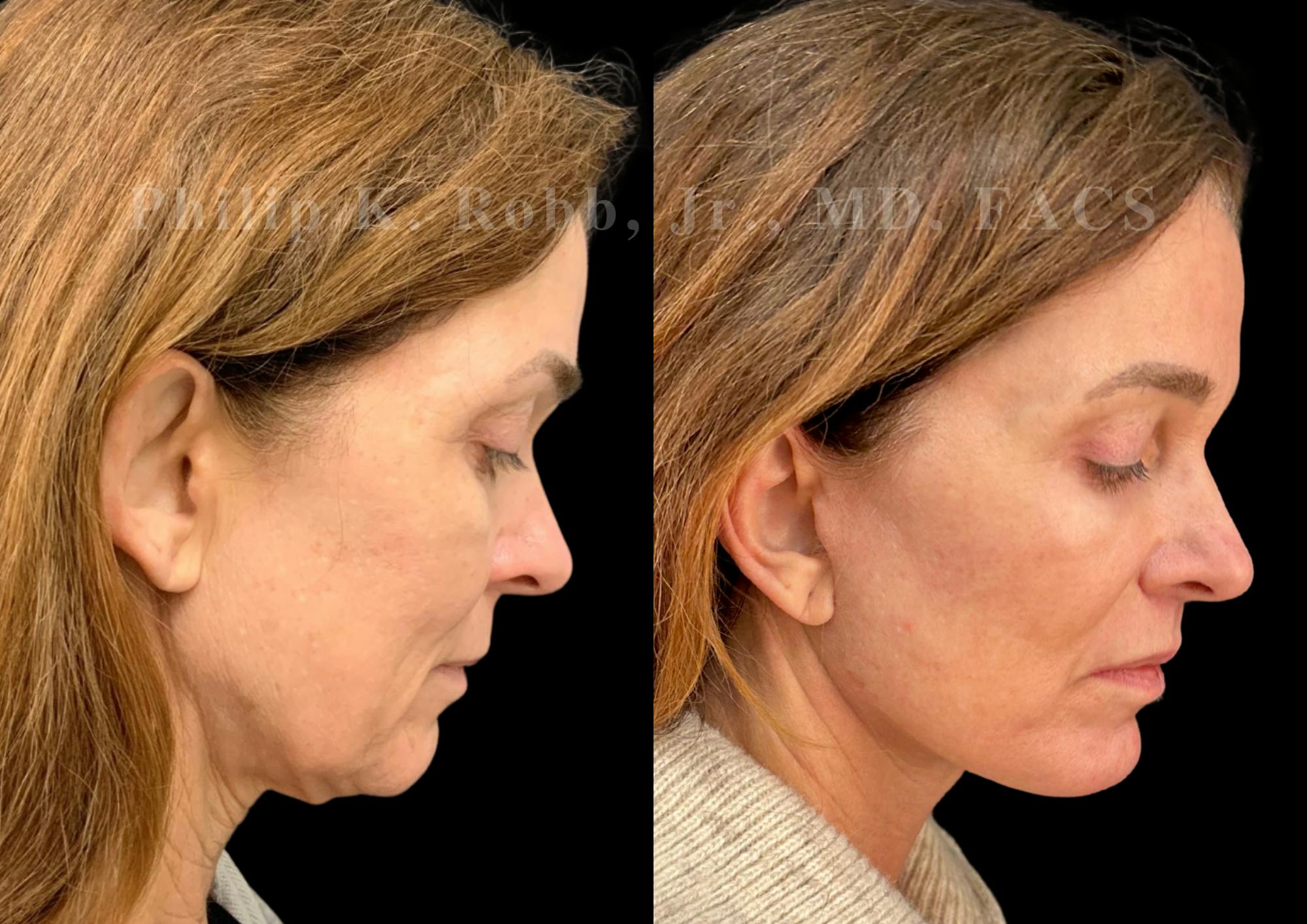 The Robb Refresh Before & After Gallery - Patient 397998 - Image 6