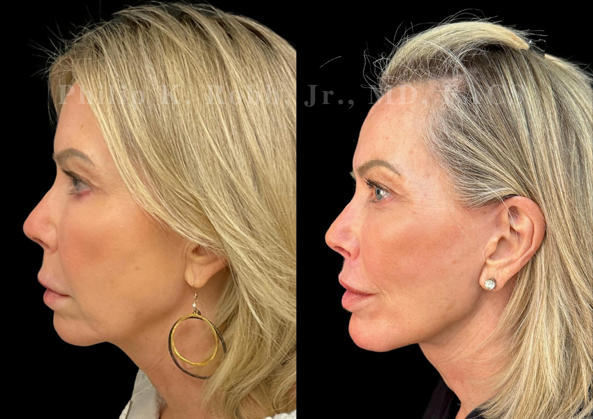 The Robb Refresh Before & After Gallery - Patient 422930 - Image 6