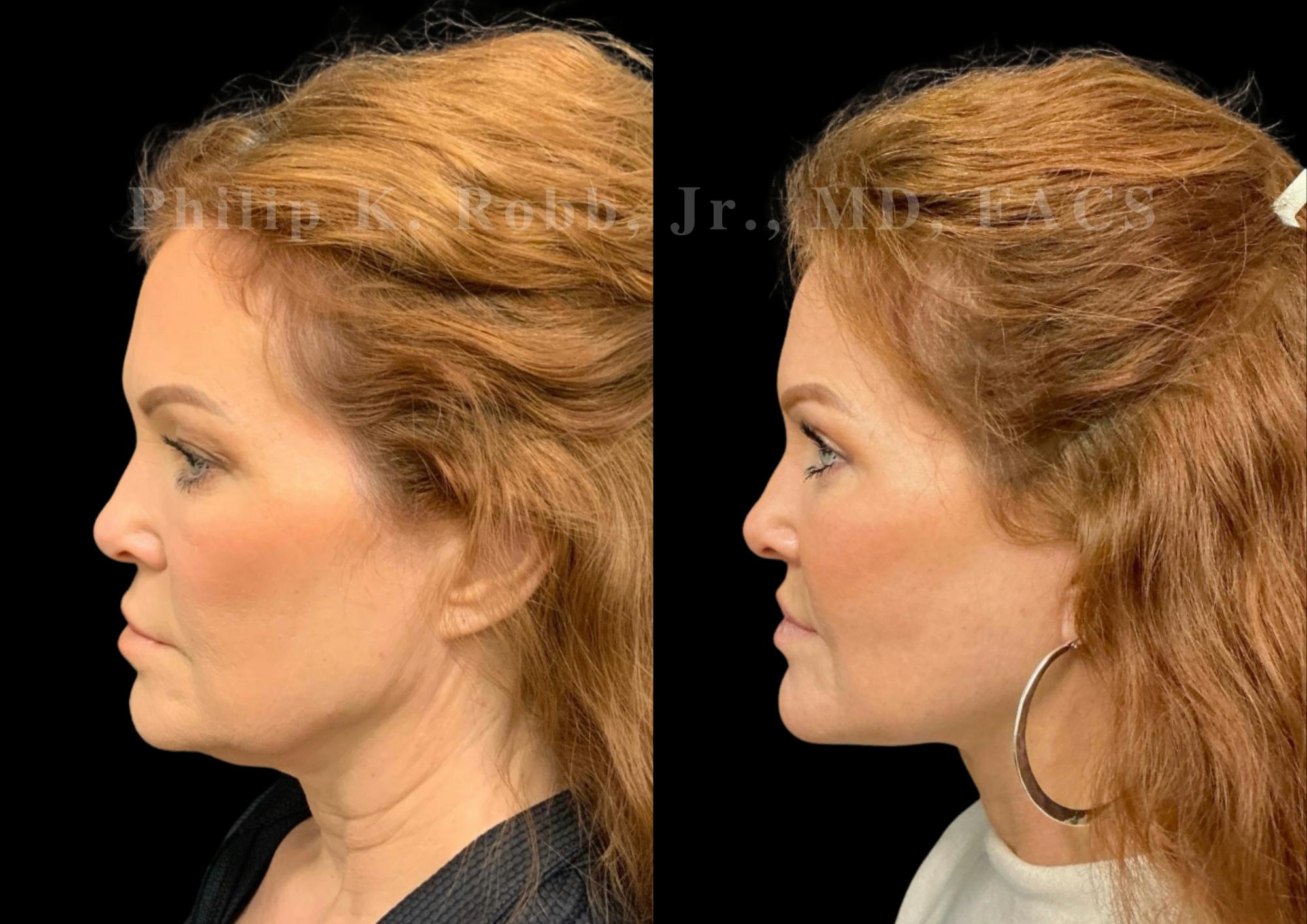 The Robb Refresh Before & After Gallery - Patient 189695 - Image 4