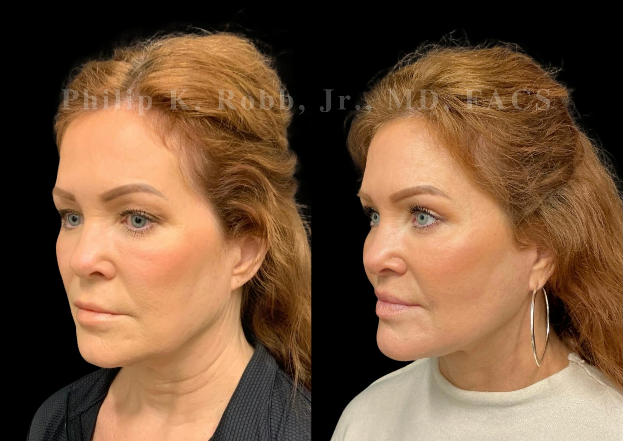 The Robb Refresh Before & After Gallery - Patient 189695 - Image 2