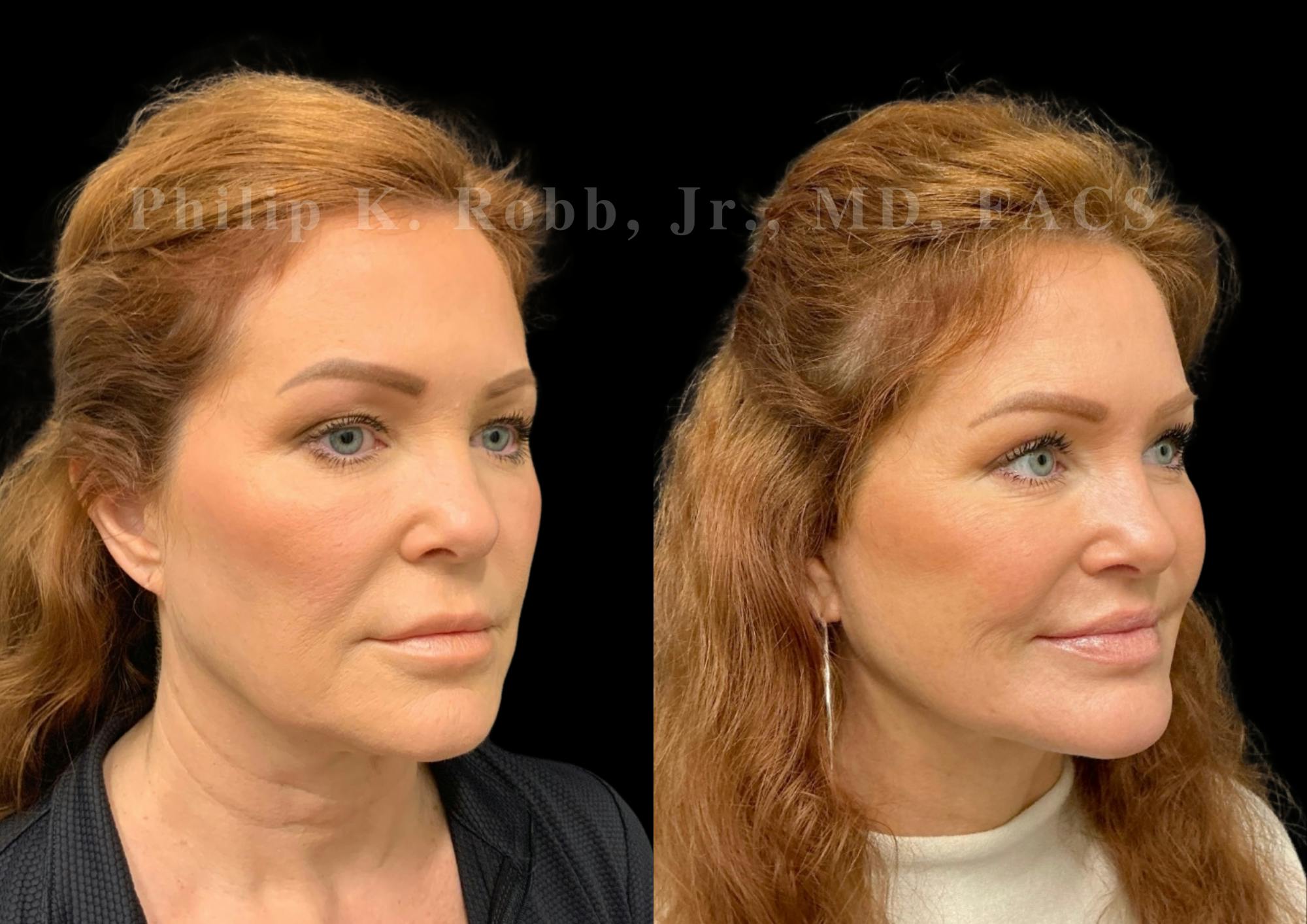 The Robb Refresh Before & After Gallery - Patient 189695 - Image 1