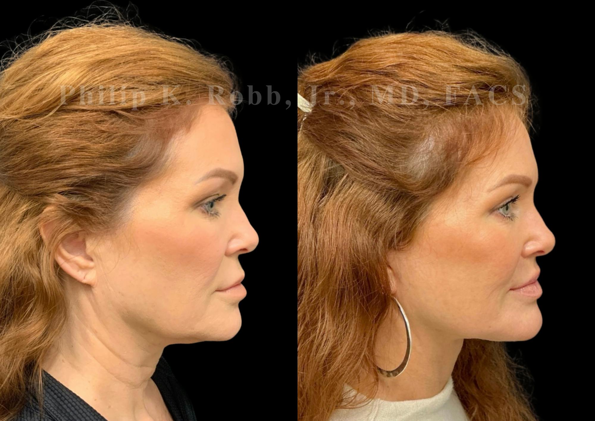 The Robb Refresh Before & After Gallery - Patient 189695 - Image 5