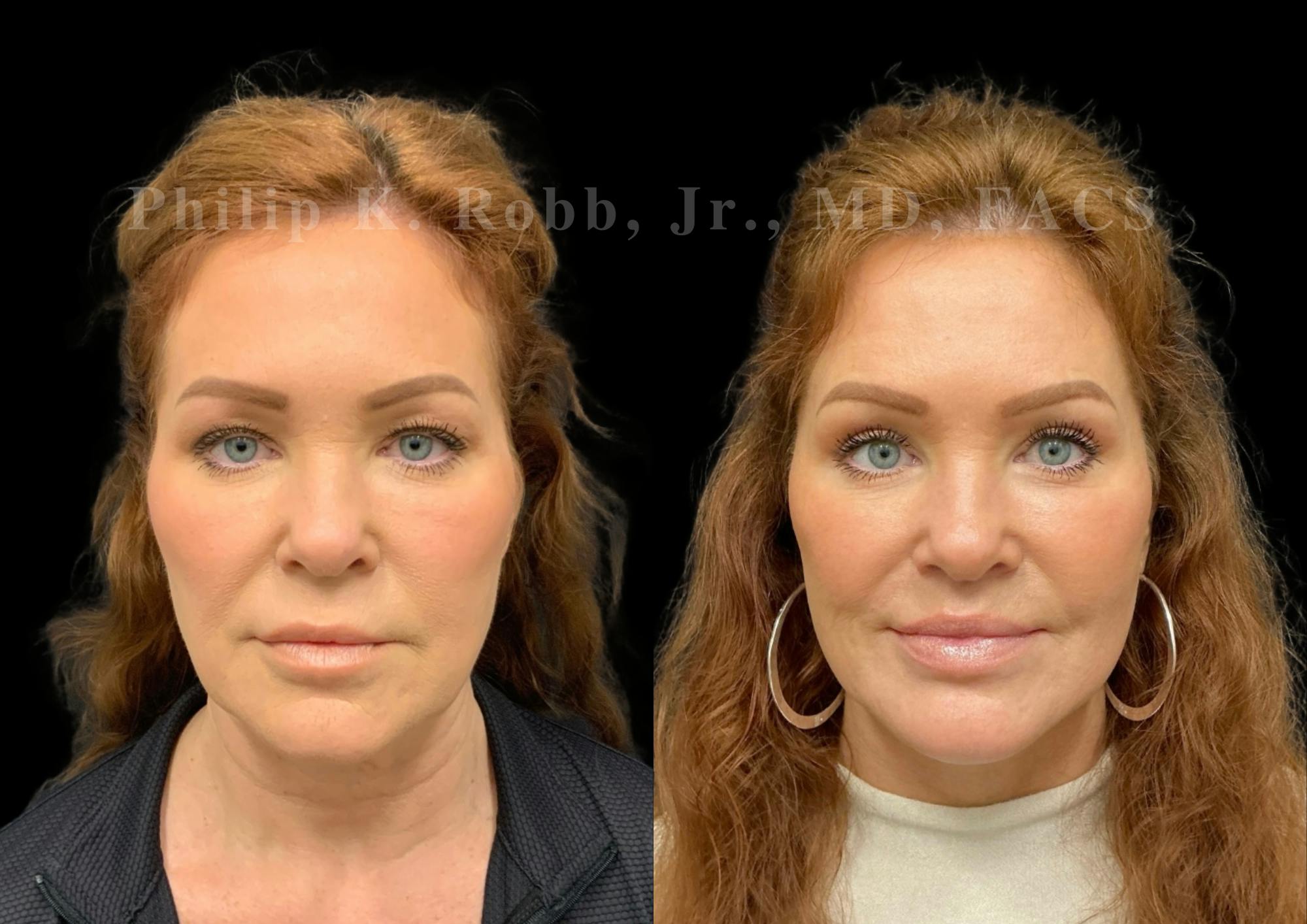 The Robb Refresh Before & After Gallery - Patient 189695 - Image 3