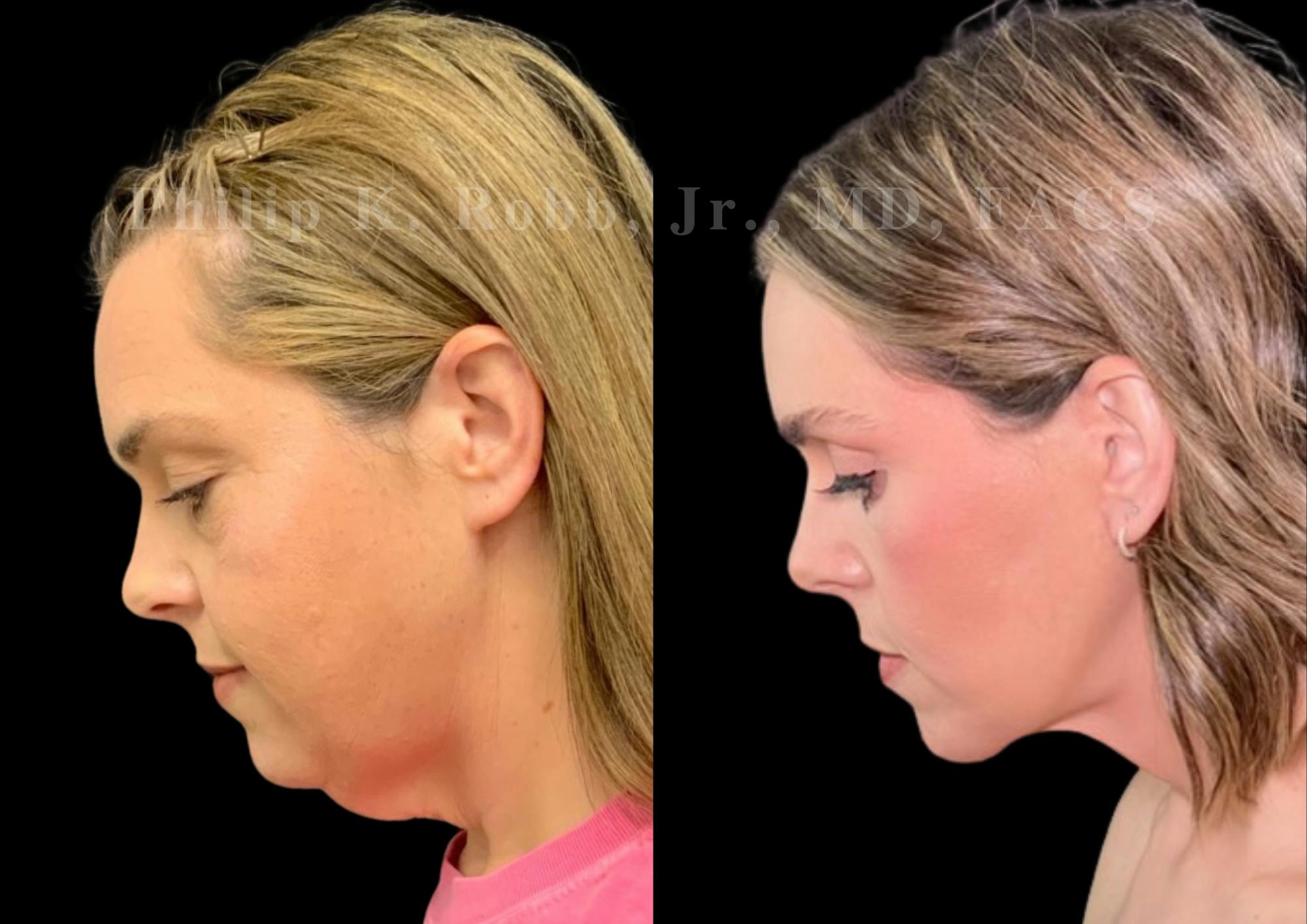 The Robb Refresh Before & After Gallery - Patient 347209 - Image 1