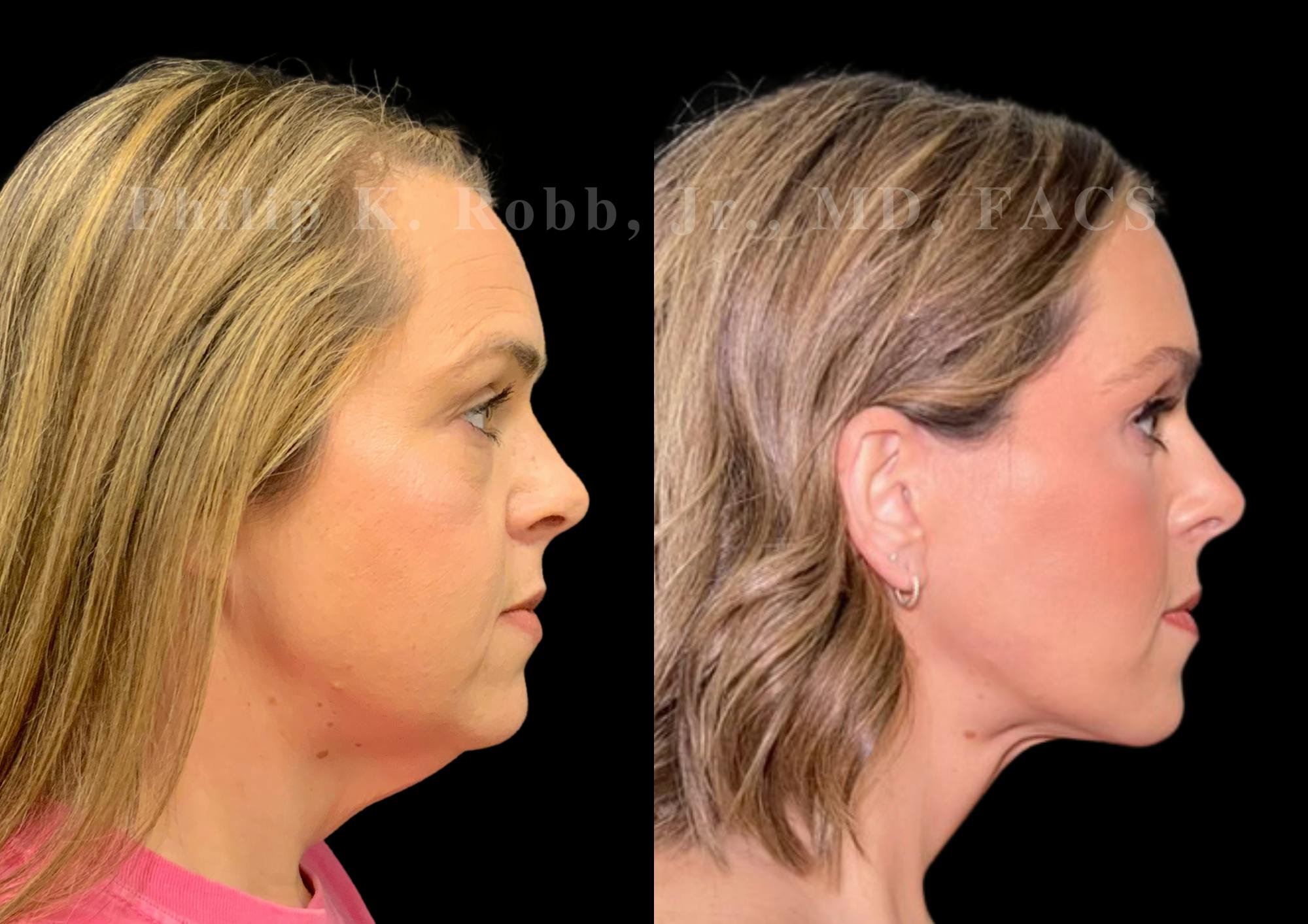 The Robb Refresh Before & After Gallery - Patient 347209 - Image 5