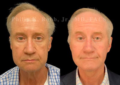 The Robb Refresh Before & After Gallery - Patient 275100 - Image 1