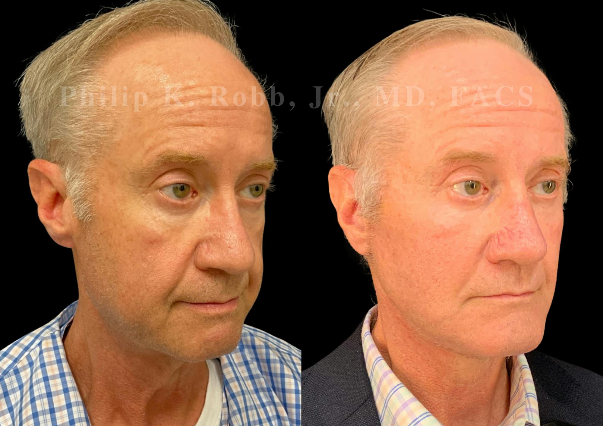 The Robb Refresh Before & After Gallery - Patient 275100 - Image 3