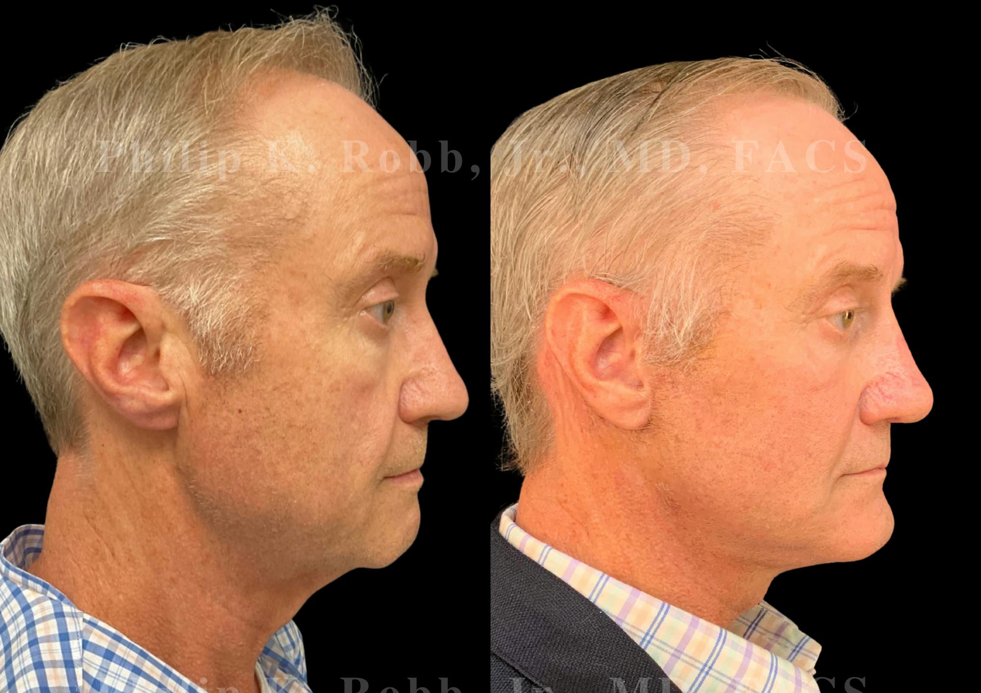The Robb Refresh Before & After Gallery - Patient 275100 - Image 1
