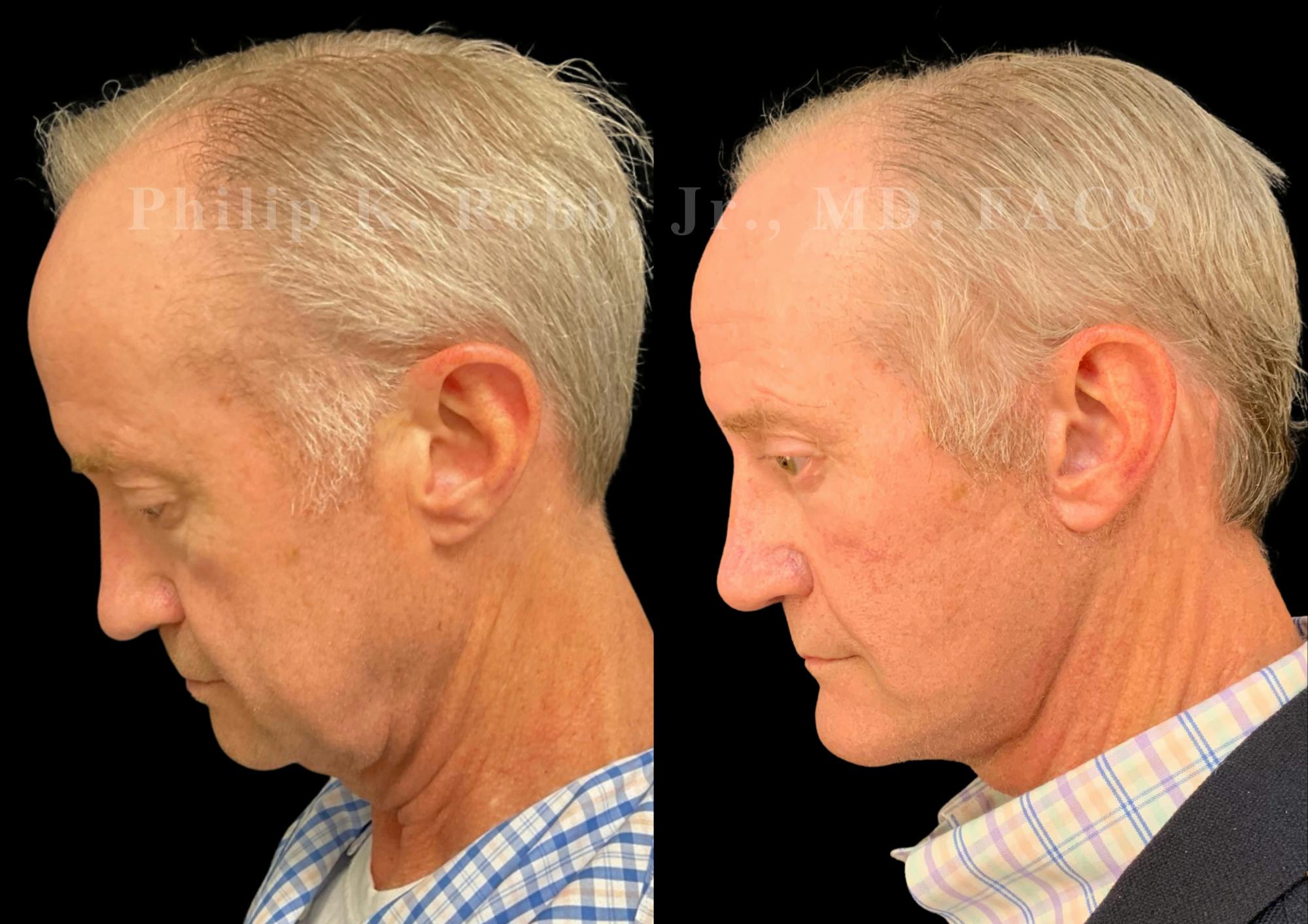 The Robb Refresh Before & After Gallery - Patient 275100 - Image 6
