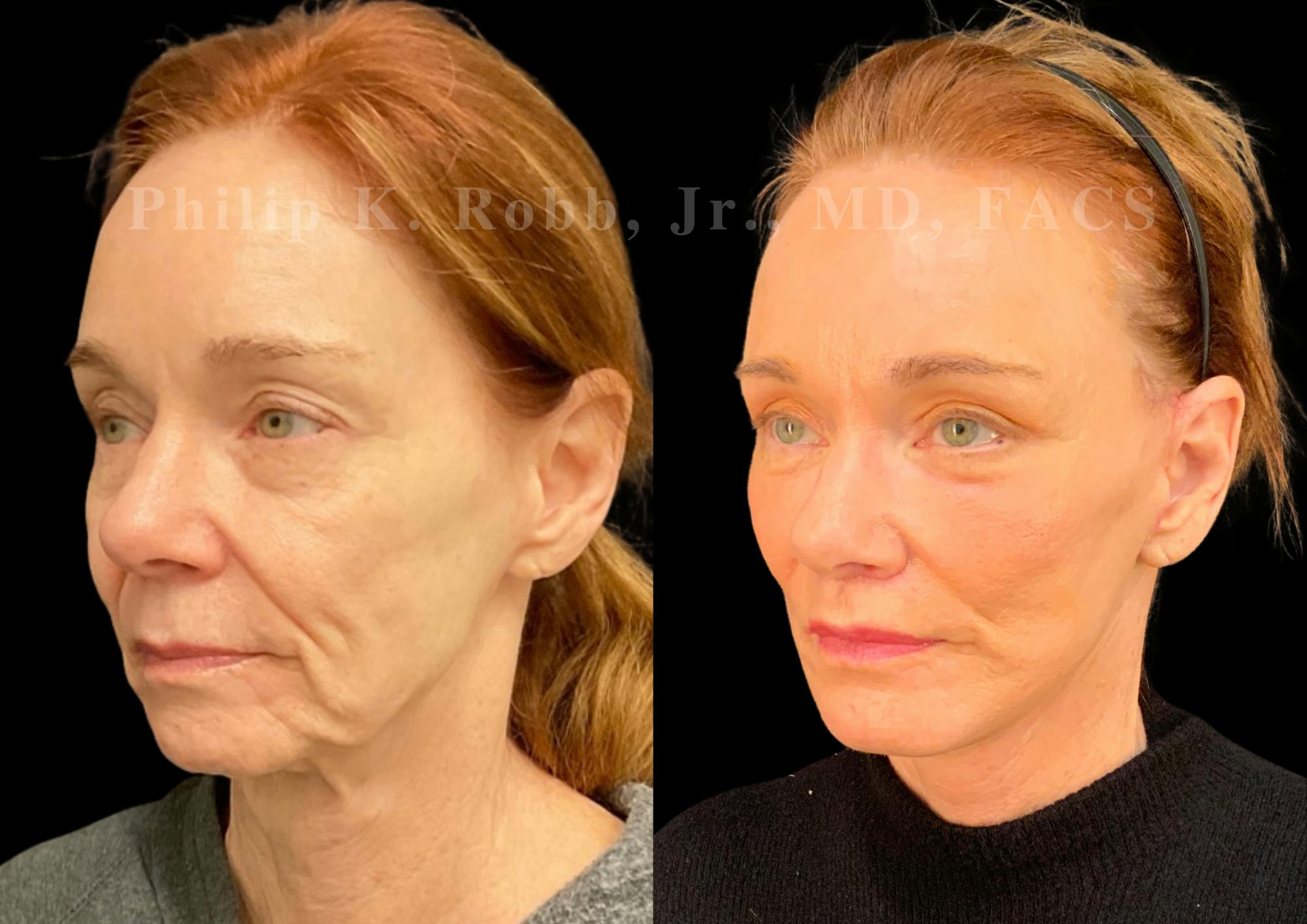 The Robb Refresh Before & After Gallery - Patient 152484 - Image 5