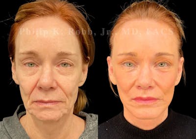 The Robb Refresh Before & After Gallery - Patient 152484 - Image 1
