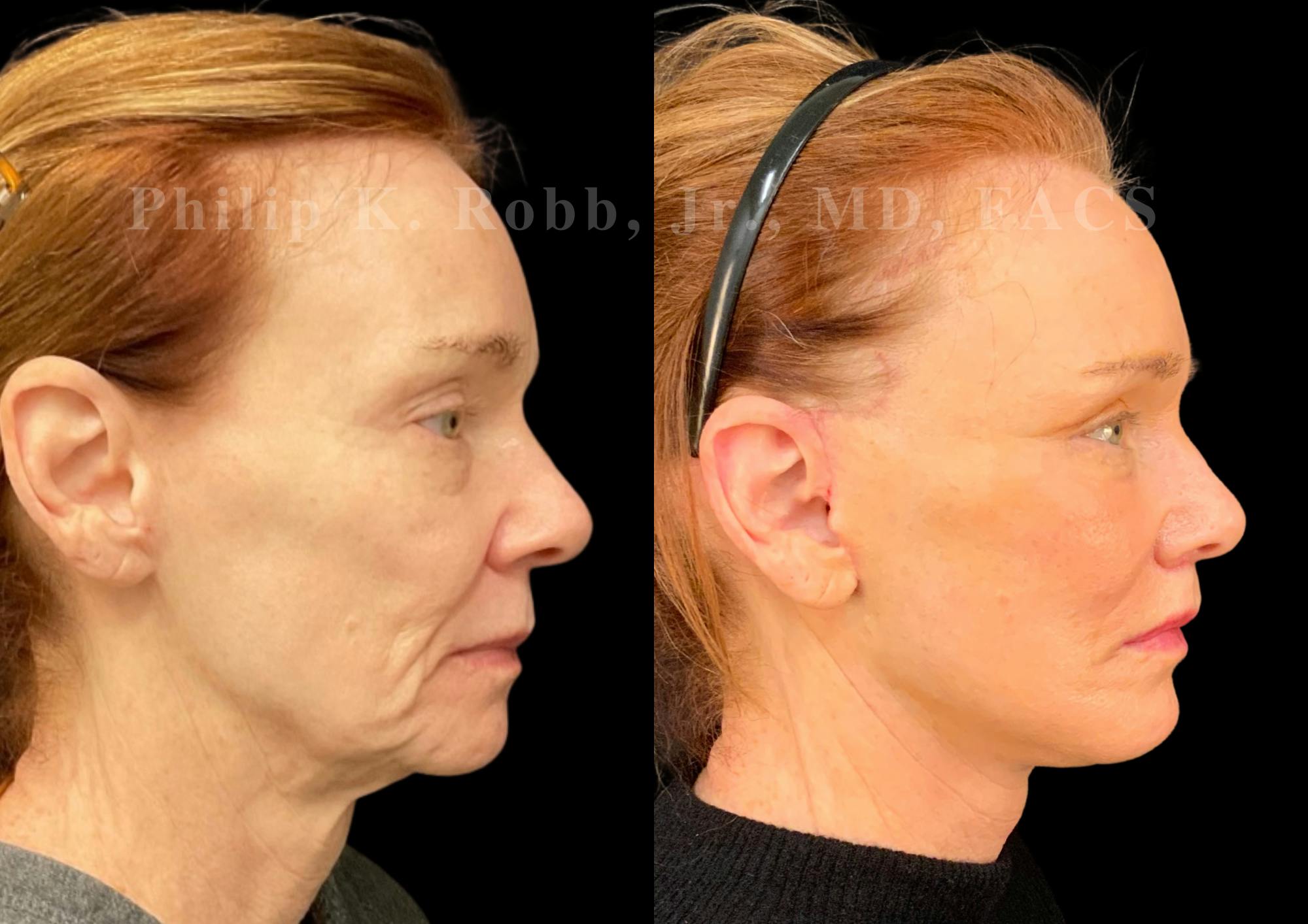 The Robb Refresh Before & After Gallery - Patient 152484 - Image 1