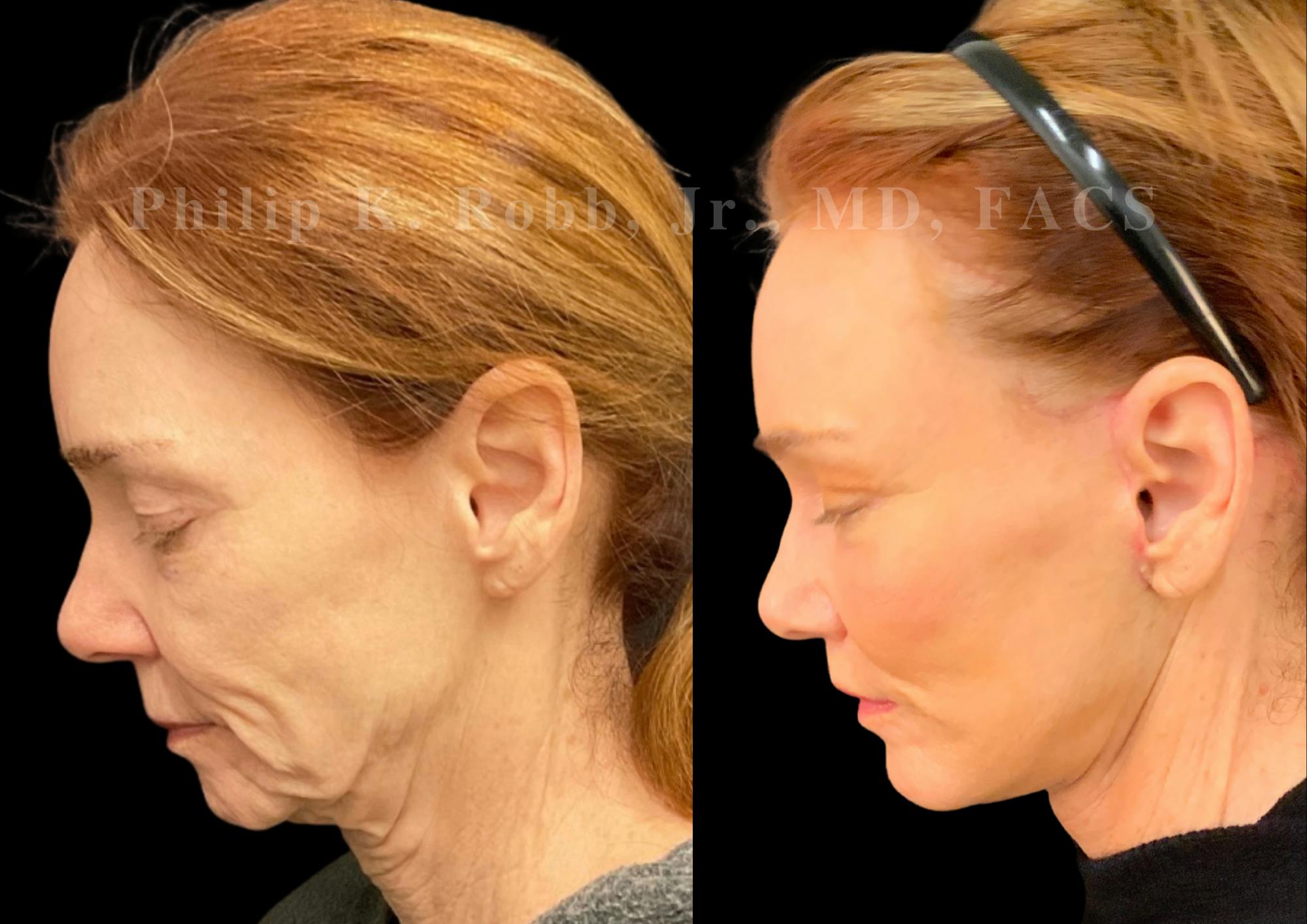 The Robb Refresh Before & After Gallery - Patient 152484 - Image 6