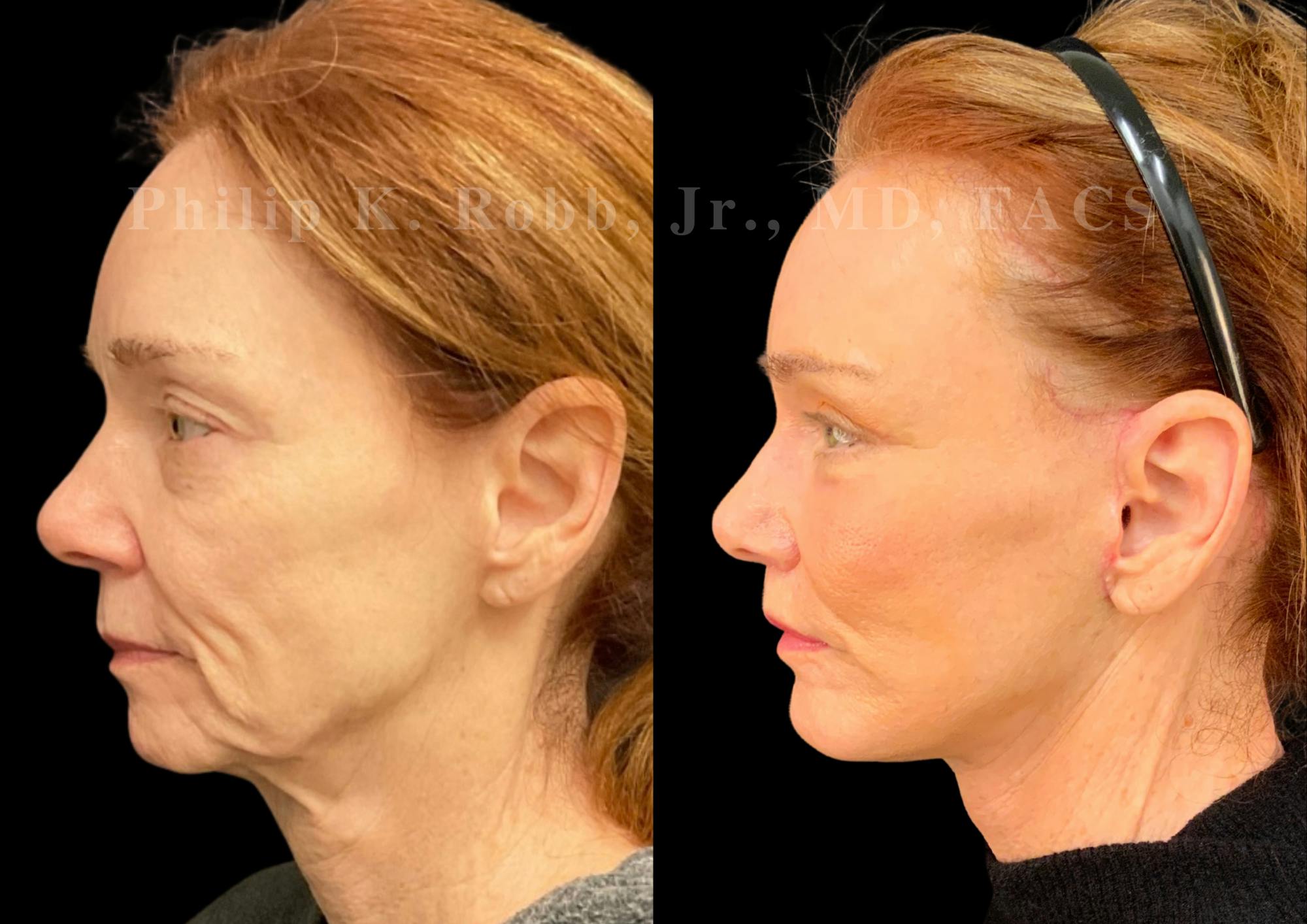 The Robb Refresh Before & After Gallery - Patient 152484 - Image 7