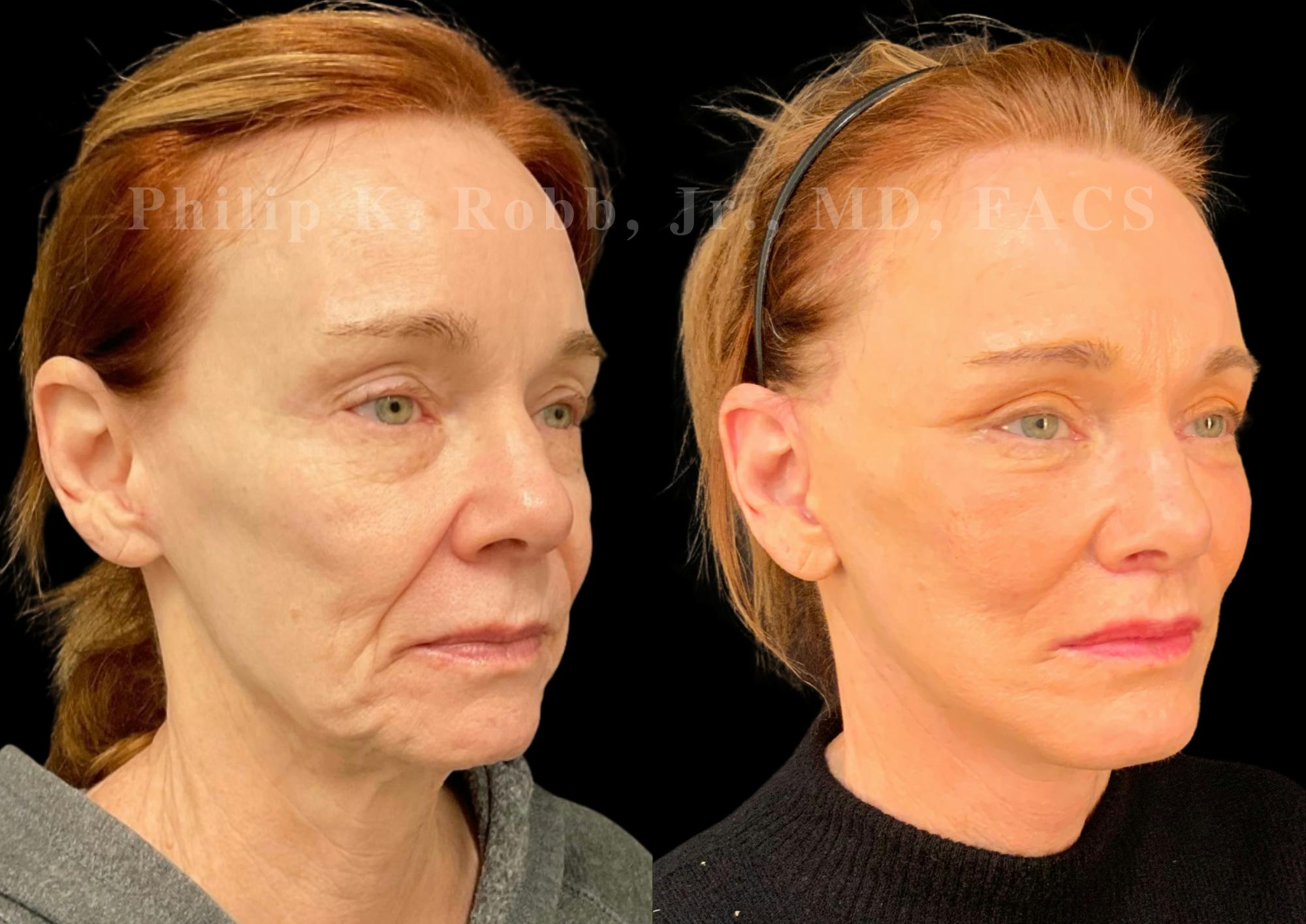 The Robb Refresh Before & After Gallery - Patient 152484 - Image 3