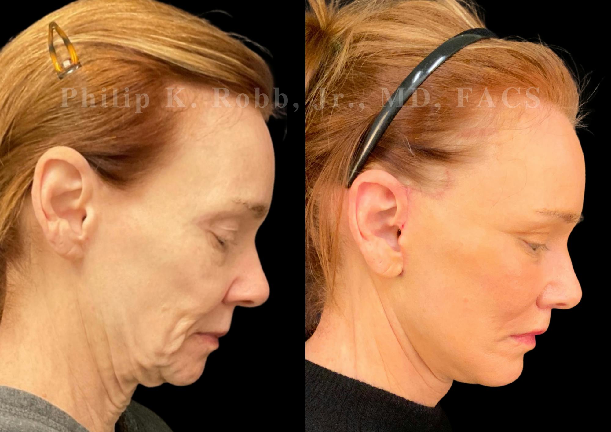 The Robb Refresh Before & After Gallery - Patient 152484 - Image 2