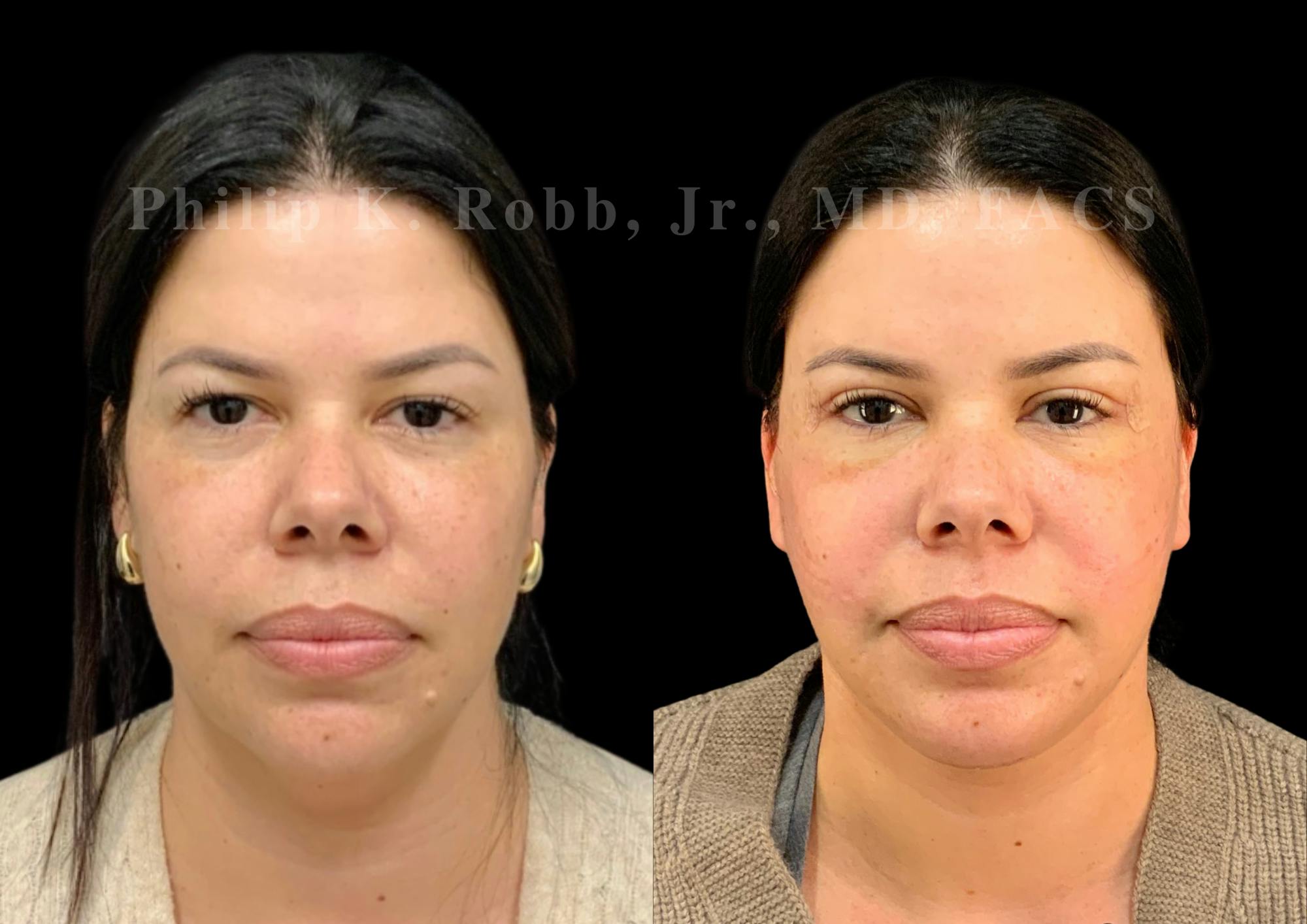 The Robb Refresh Before & After Gallery - Patient 128631 - Image 3