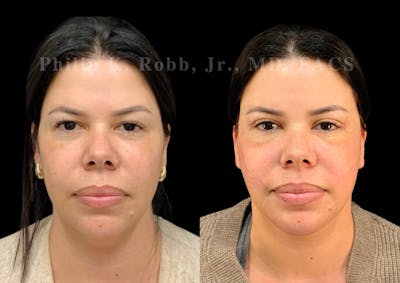 The Robb Refresh Before & After Gallery - Patient 128631 - Image 1