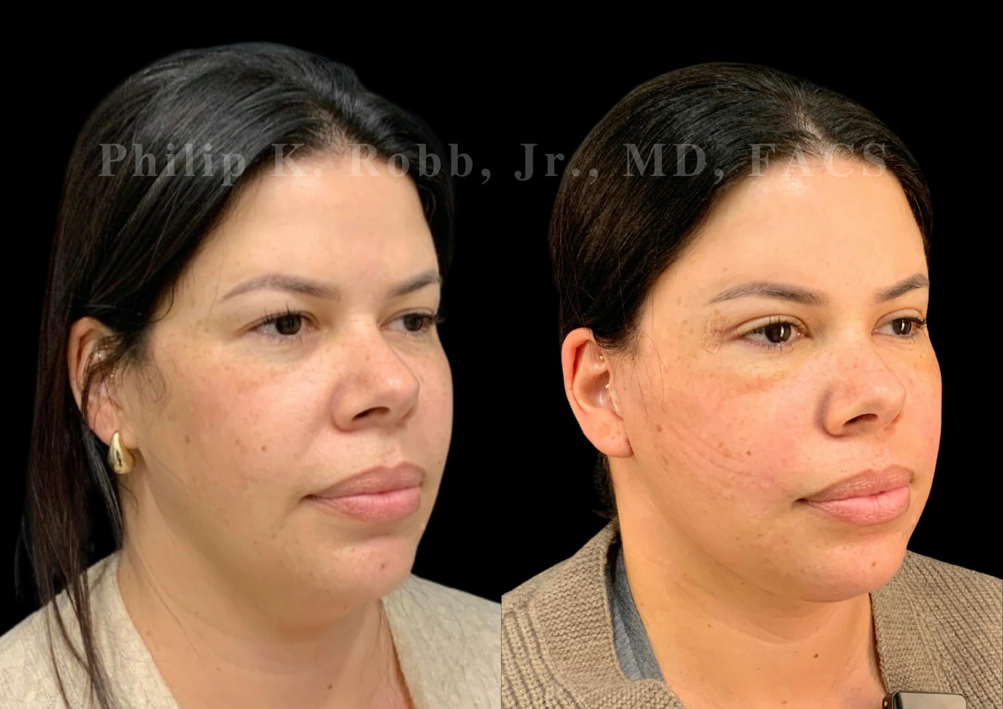 The Robb Refresh Before & After Gallery - Patient 128631 - Image 2