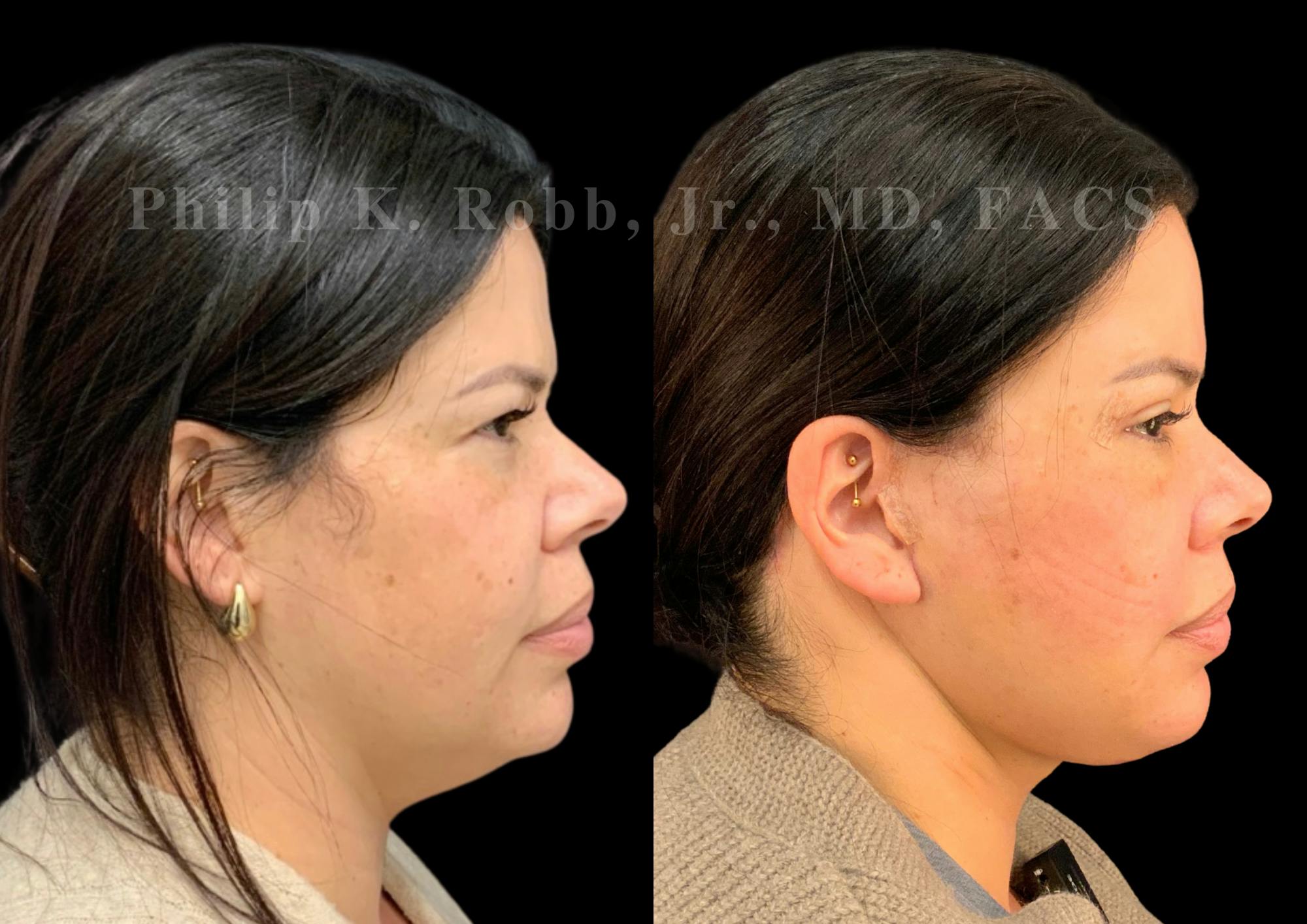 The Robb Refresh Before & After Gallery - Patient 128631 - Image 1