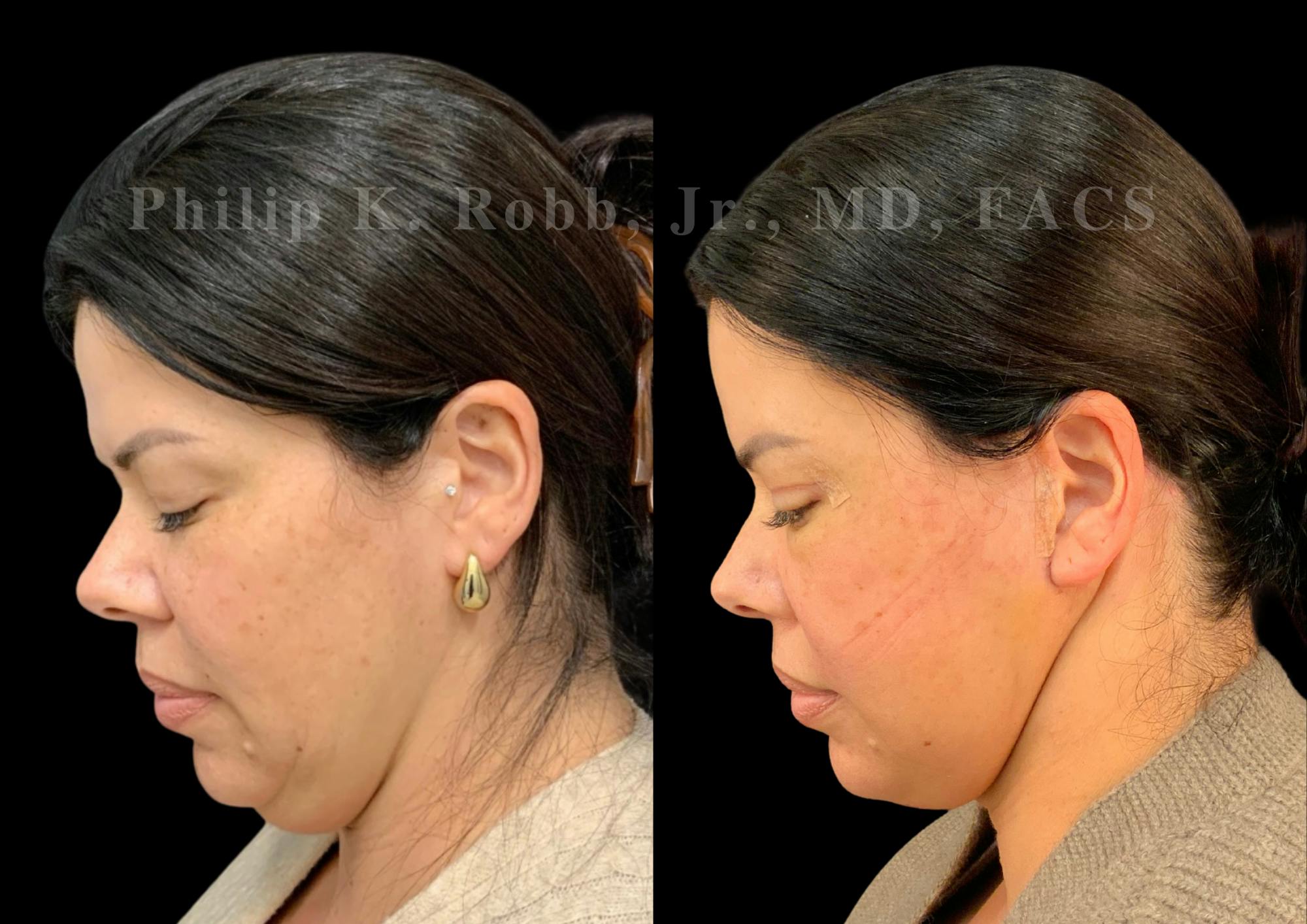 The Robb Refresh Before & After Gallery - Patient 128631 - Image 5