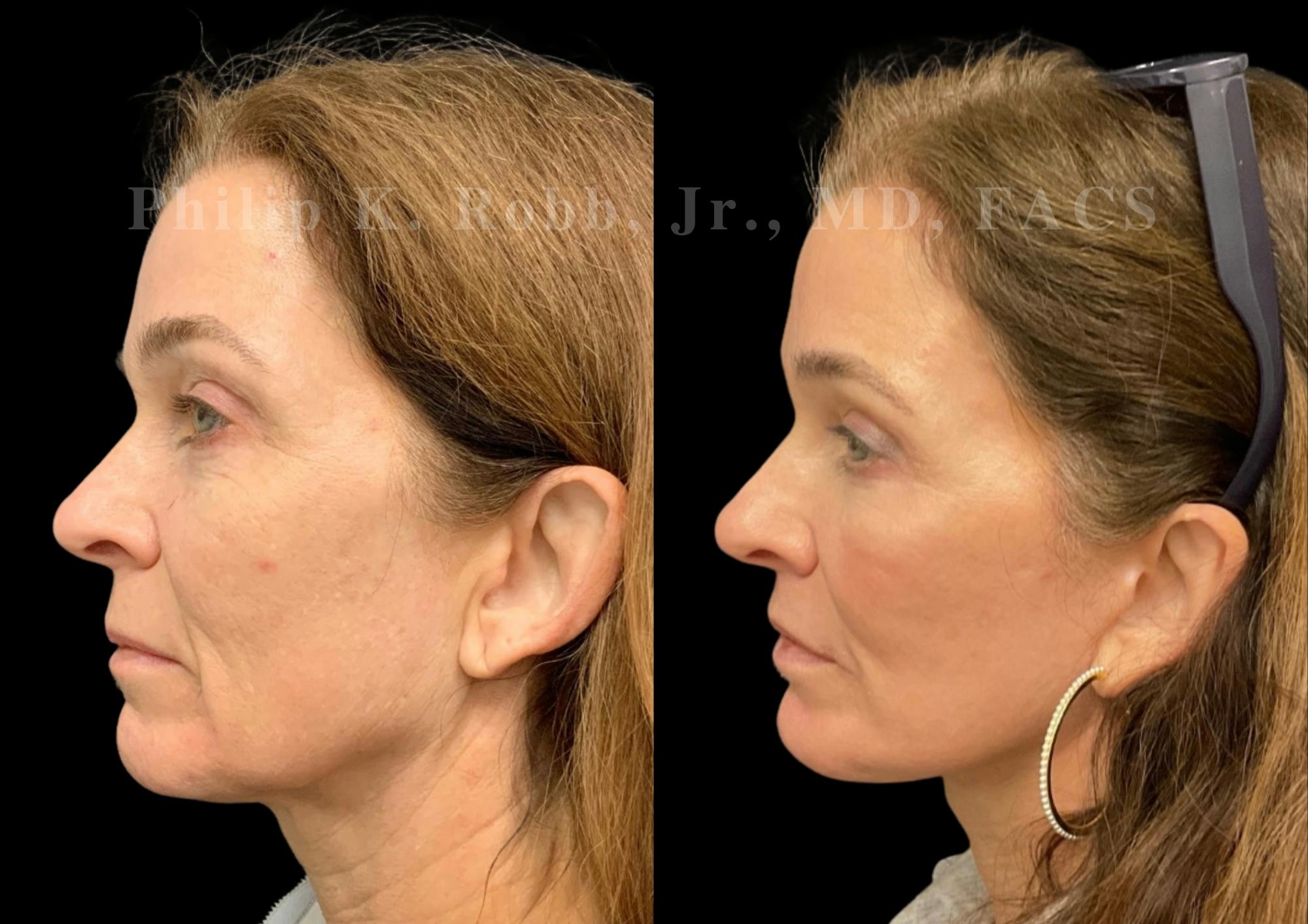 Upper Blepharoplasty Before & After Gallery - Patient 504058 - Image 2
