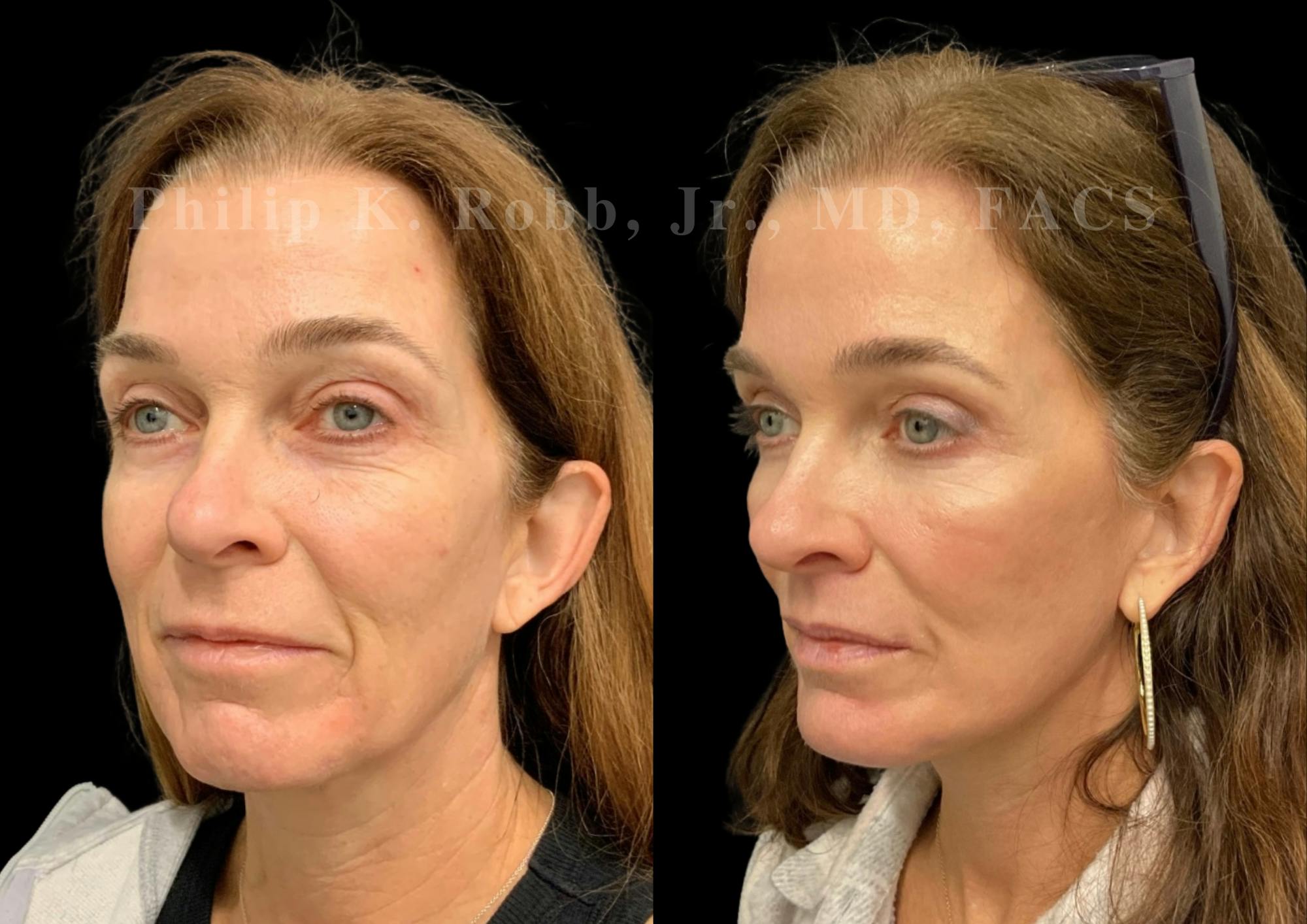 Upper Blepharoplasty Before & After Gallery - Patient 504058 - Image 3